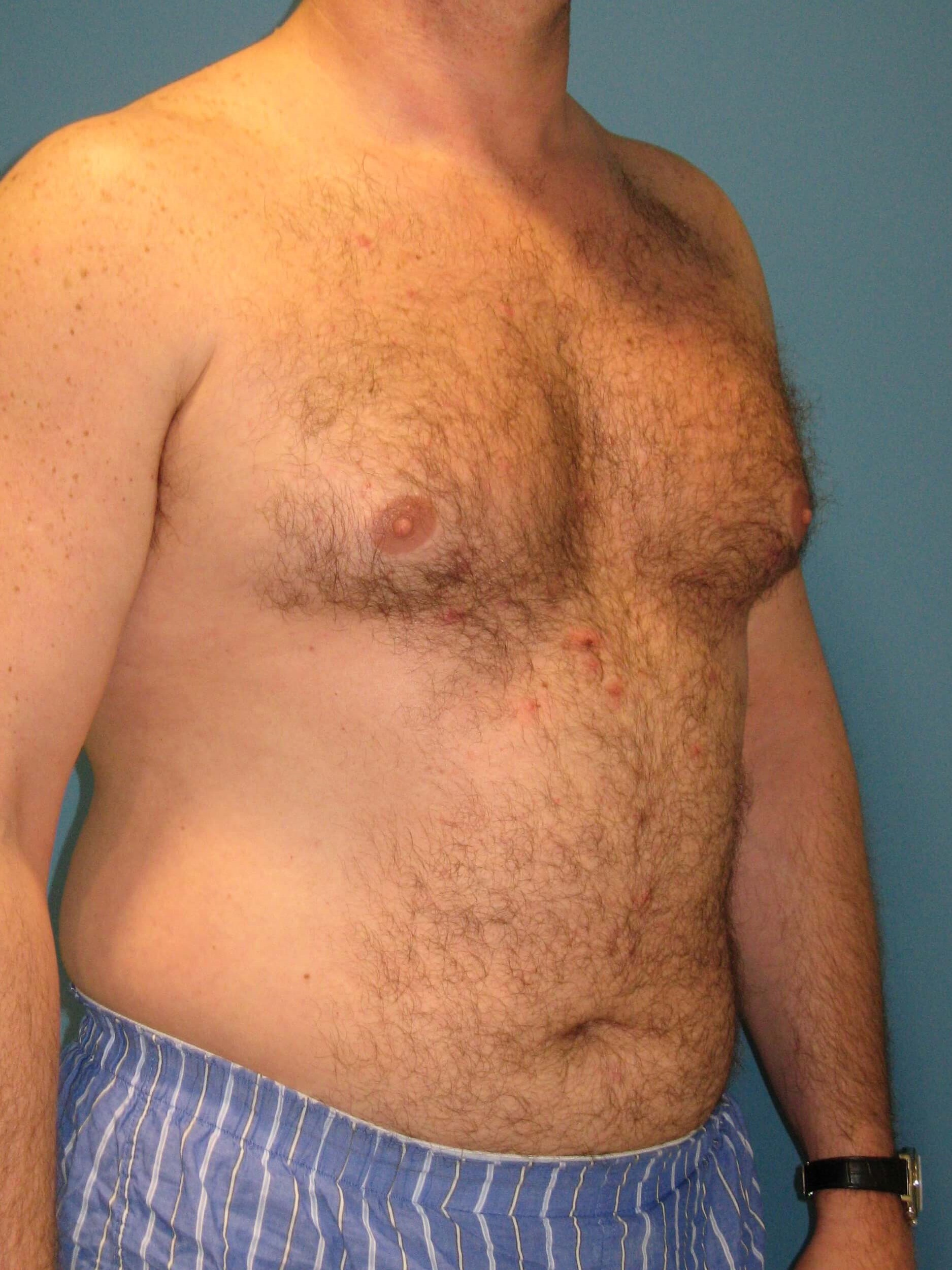 Male Liposuction of Abdomen, Flanks and Back