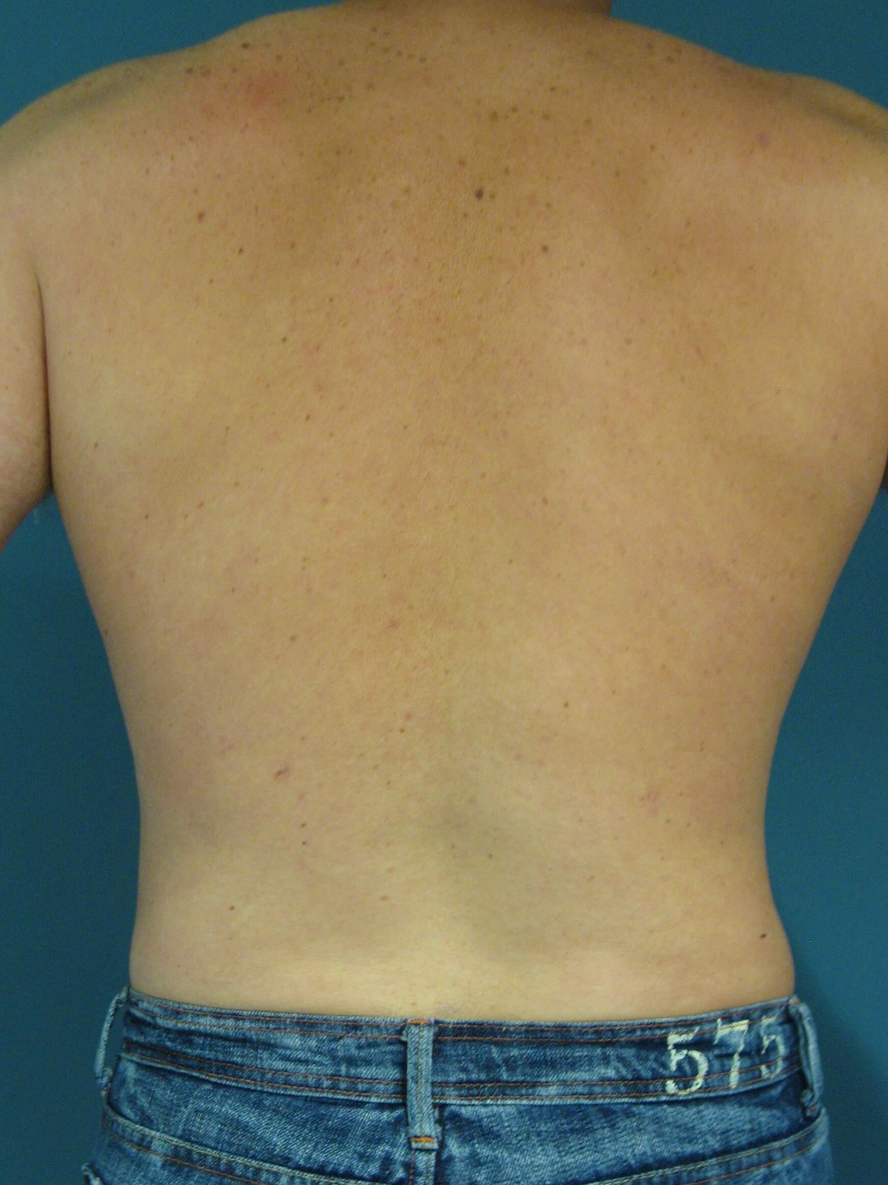 Male Liposuction of Abdomen, Flanks and Back — after, view 2