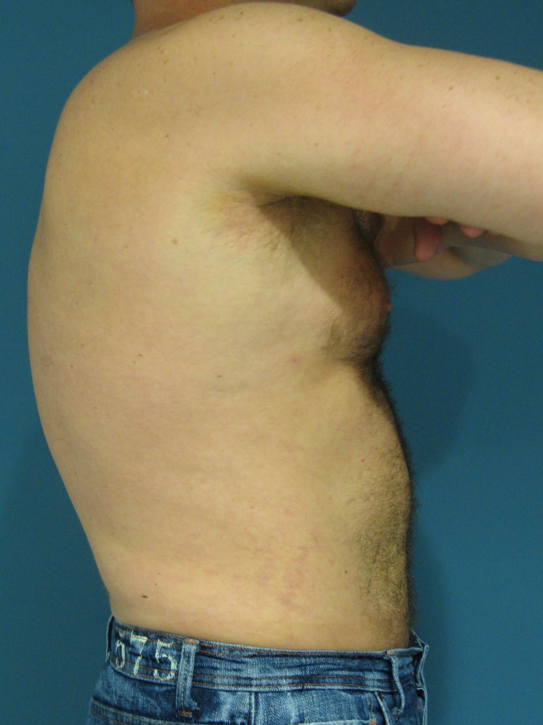 Male Liposuction of Abdomen, Flanks and Back — after, view 3