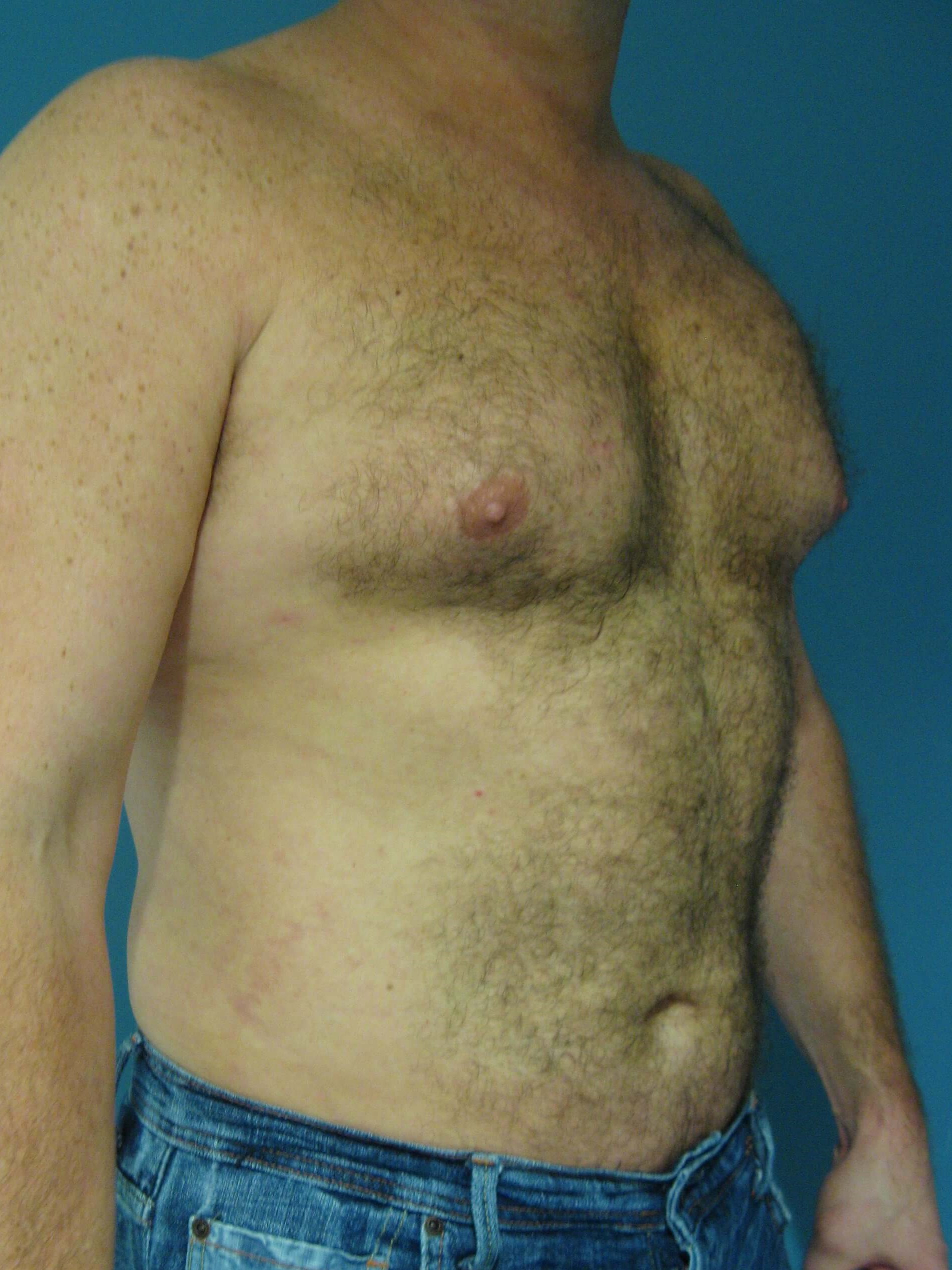 Male Liposuction of Abdomen, Flanks and Back — after, view 4