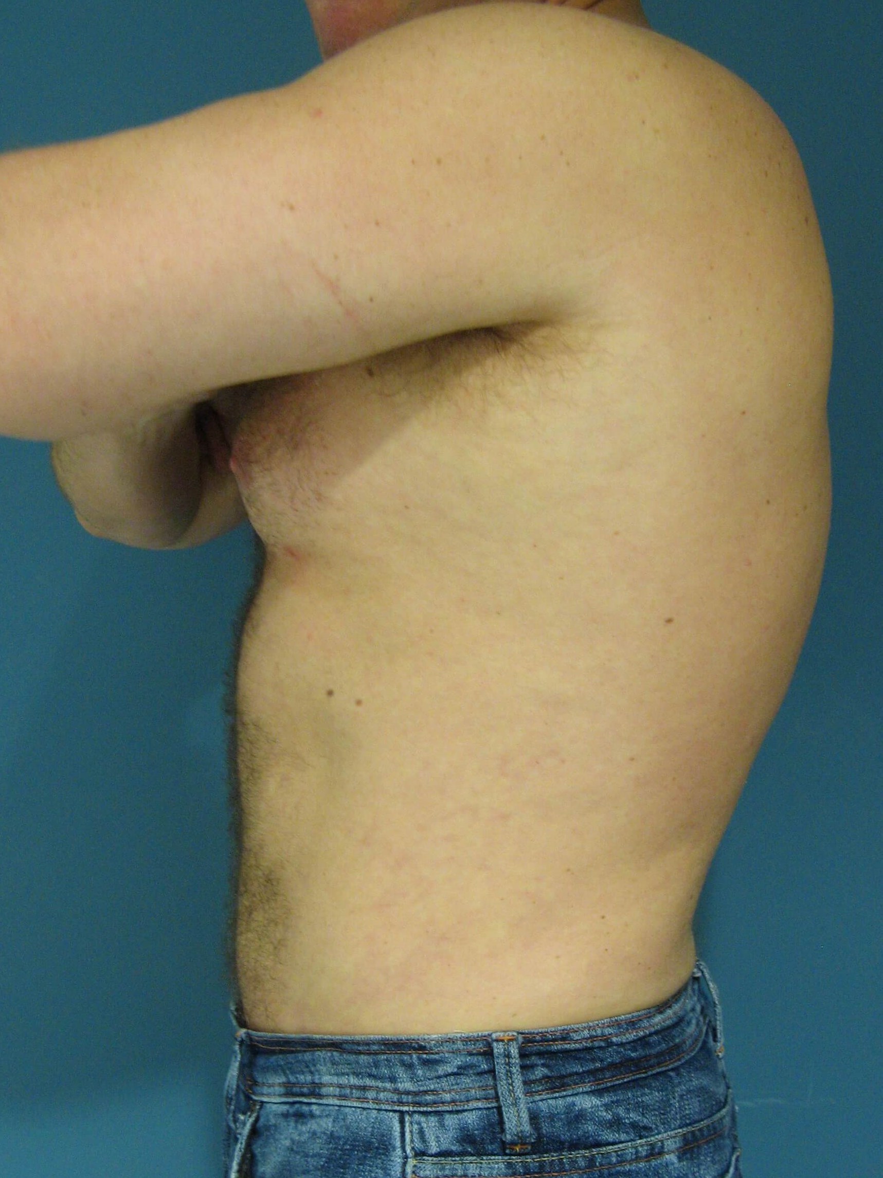 Male Liposuction of Abdomen, Flanks and Back — after, view 5
