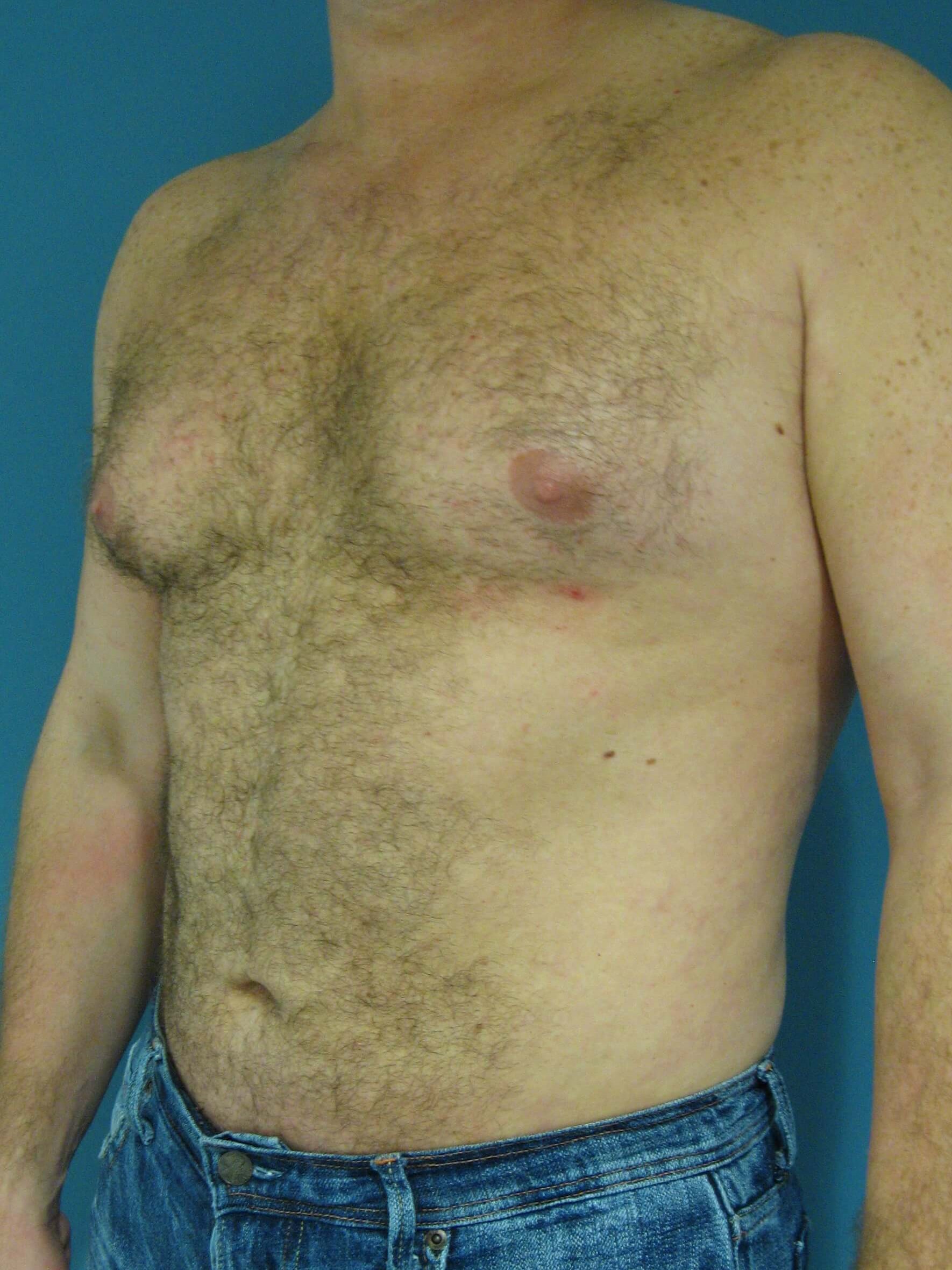 Male Liposuction of Abdomen, Flanks and Back — after, view 6