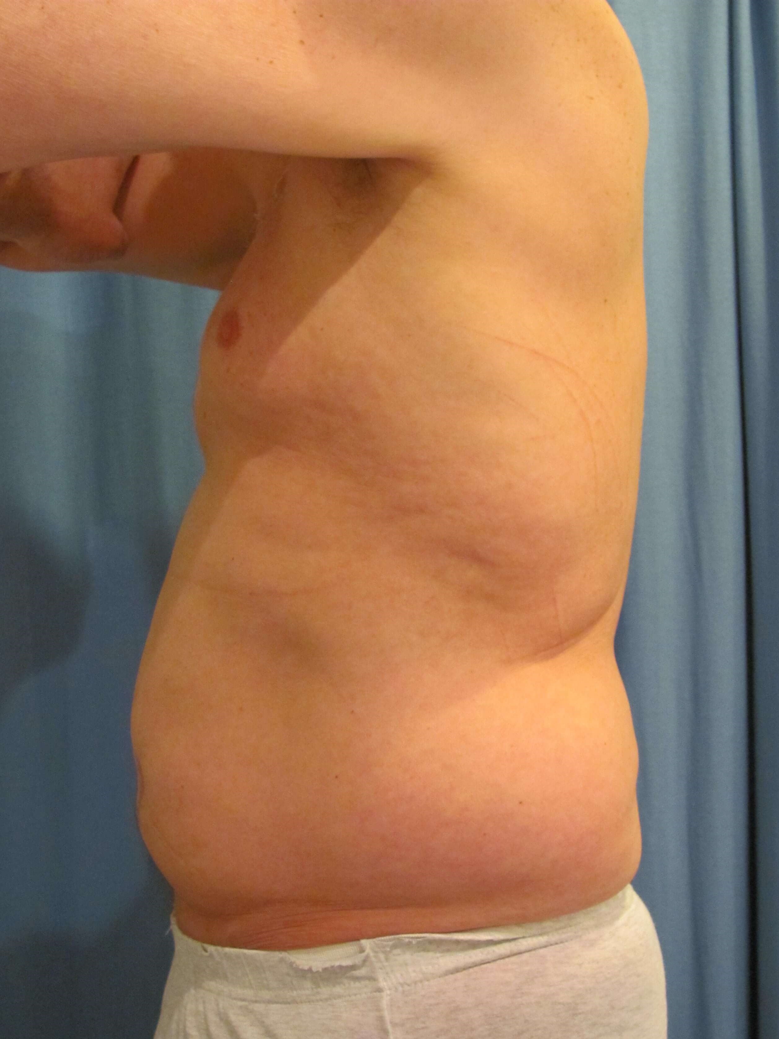Male Liposuction of Abdomen, Flanks and Chest Wall — before, view 2