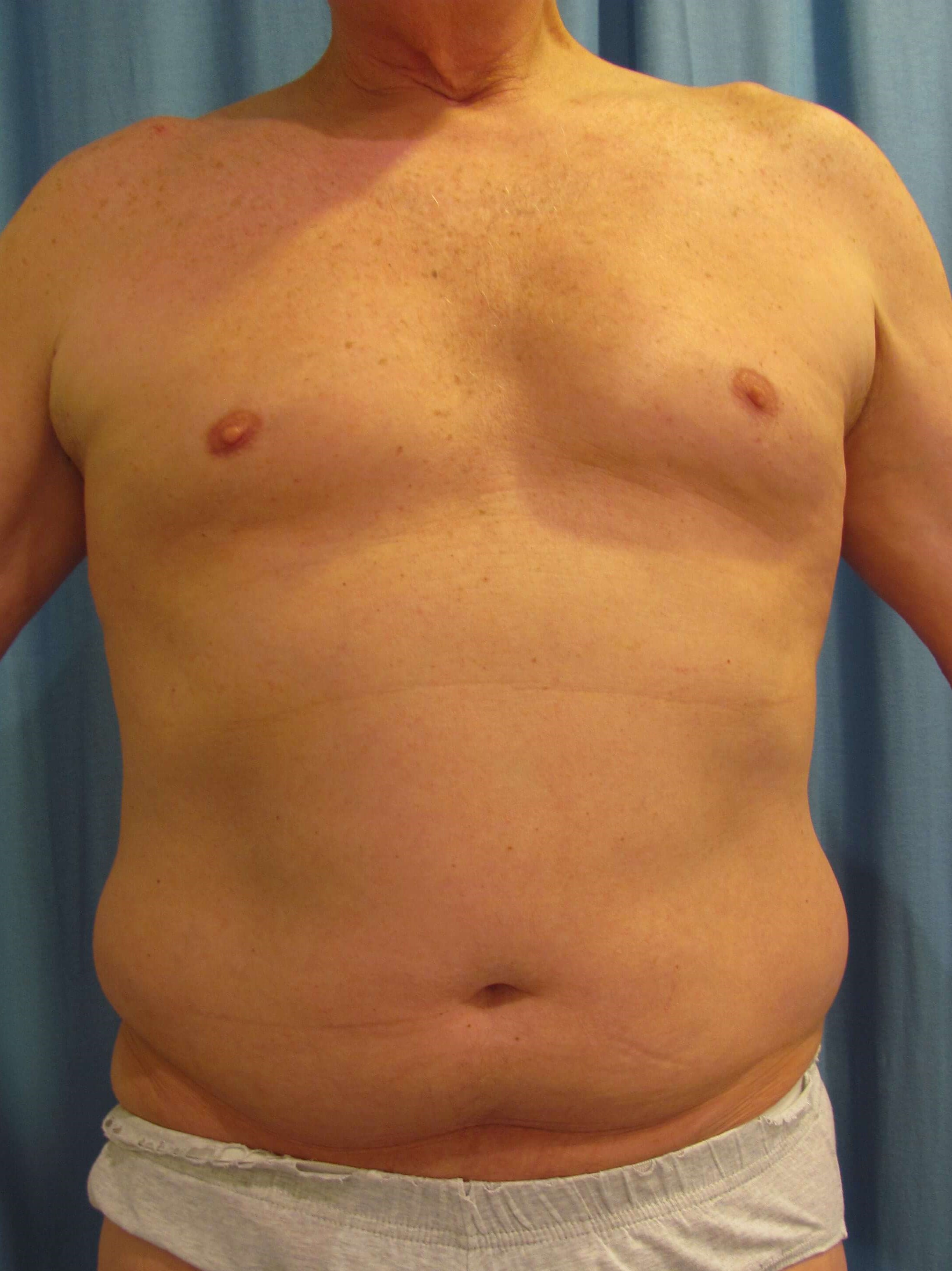 Male Liposuction of Abdomen, Flanks and Chest Wall — before, view 3