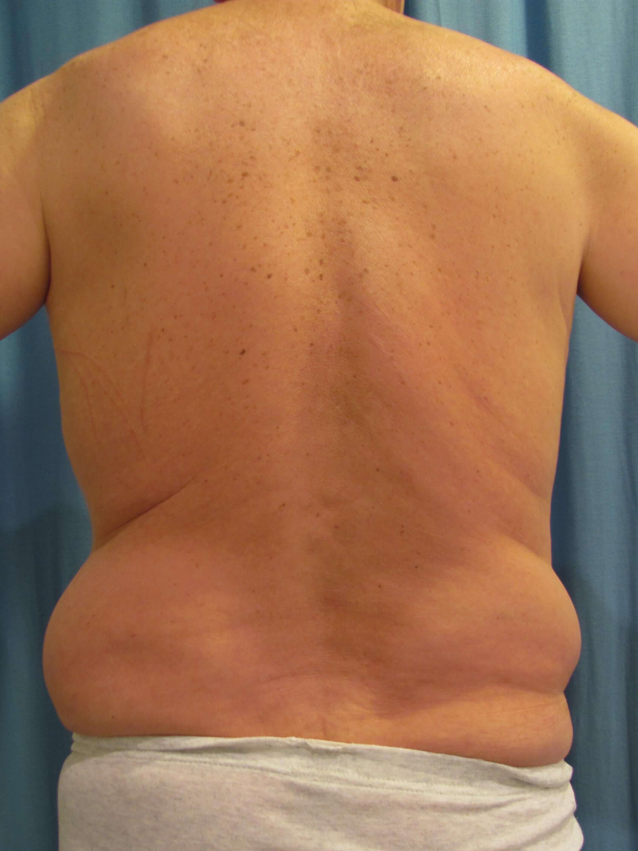 Male Liposuction of Abdomen, Flanks and Chest Wall — before, view 4