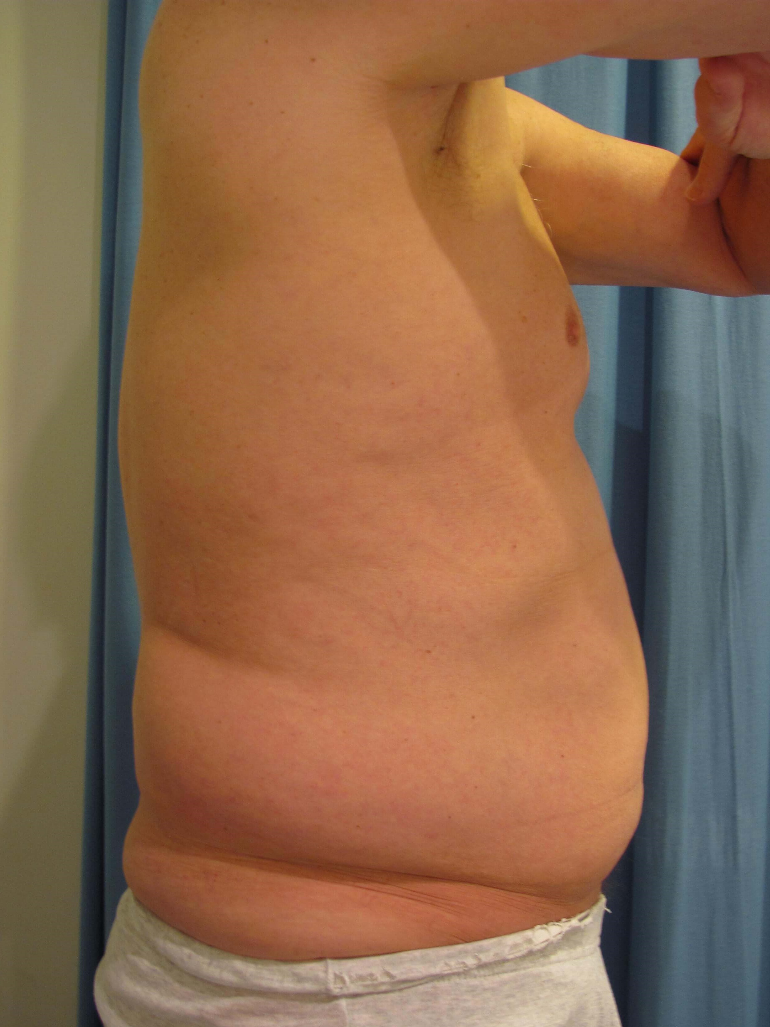 Male Liposuction of Abdomen, Flanks and Chest Wall — before, view 5