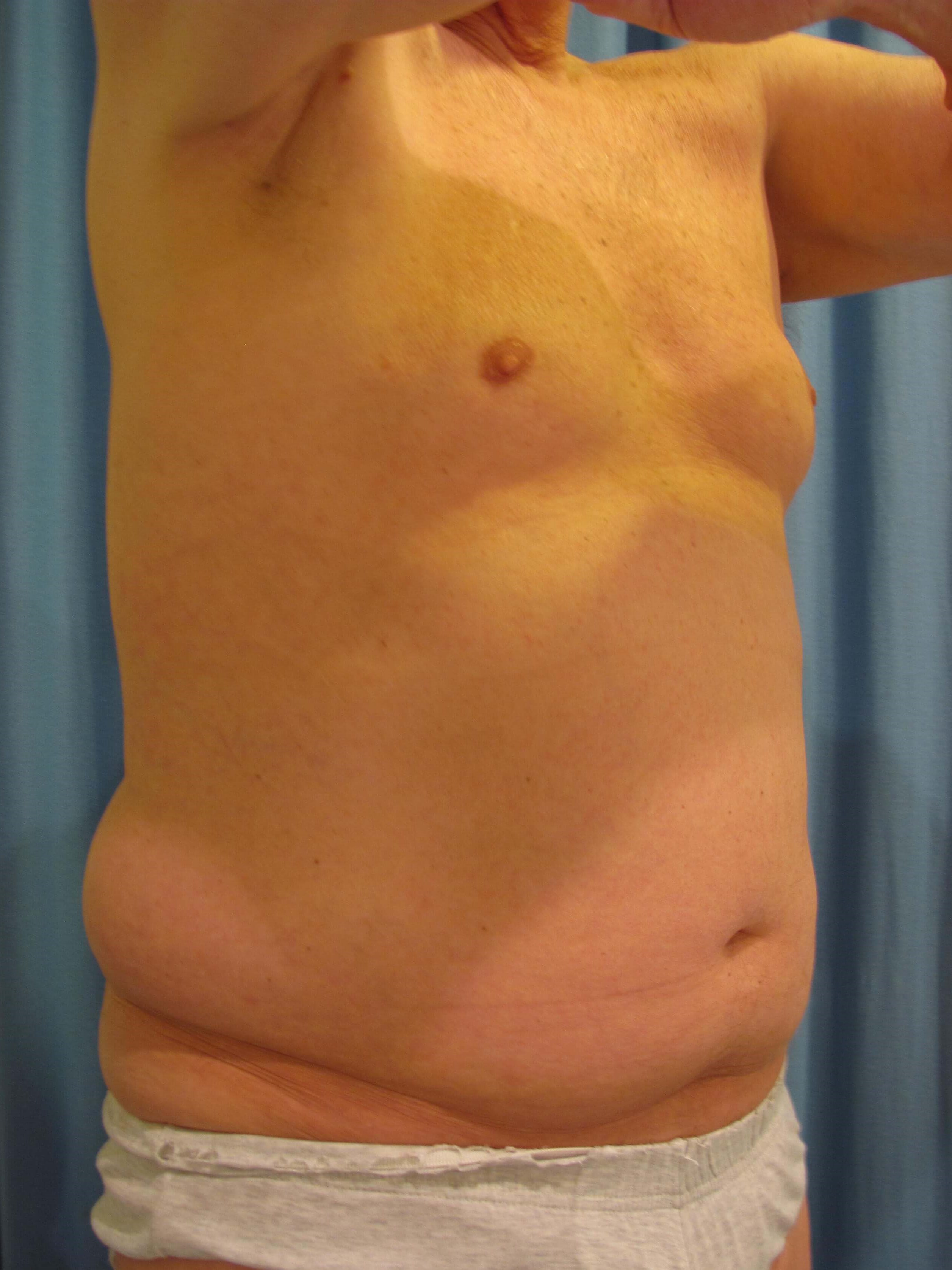 Male Liposuction of Abdomen, Flanks and Chest Wall — before, view 6