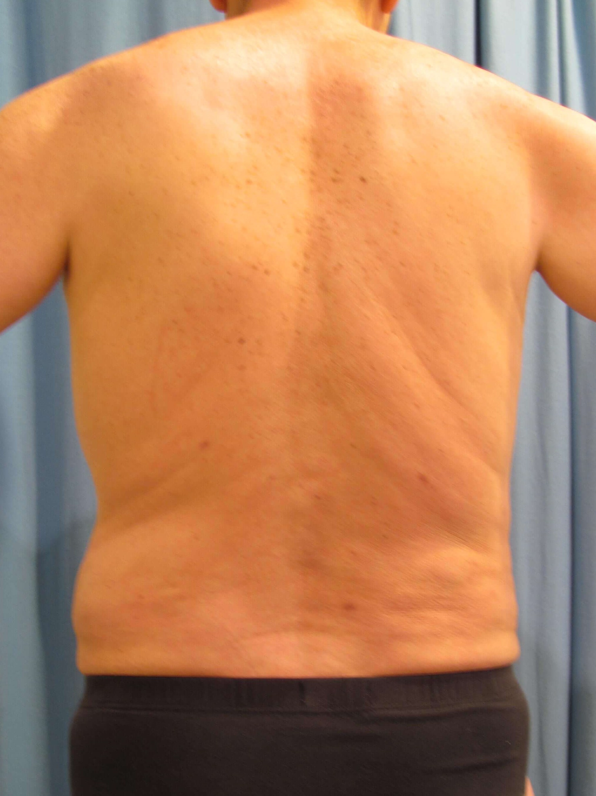 Male Liposuction of Abdomen, Flanks and Chest Wall