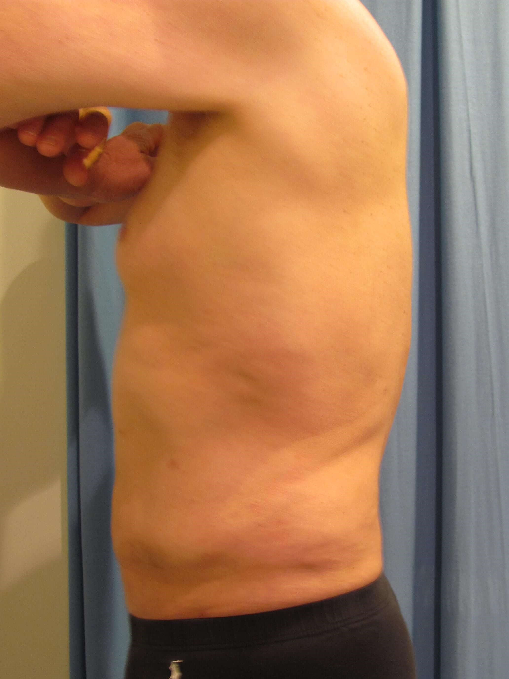 Male Liposuction of Abdomen, Flanks and Chest Wall — after, view 2
