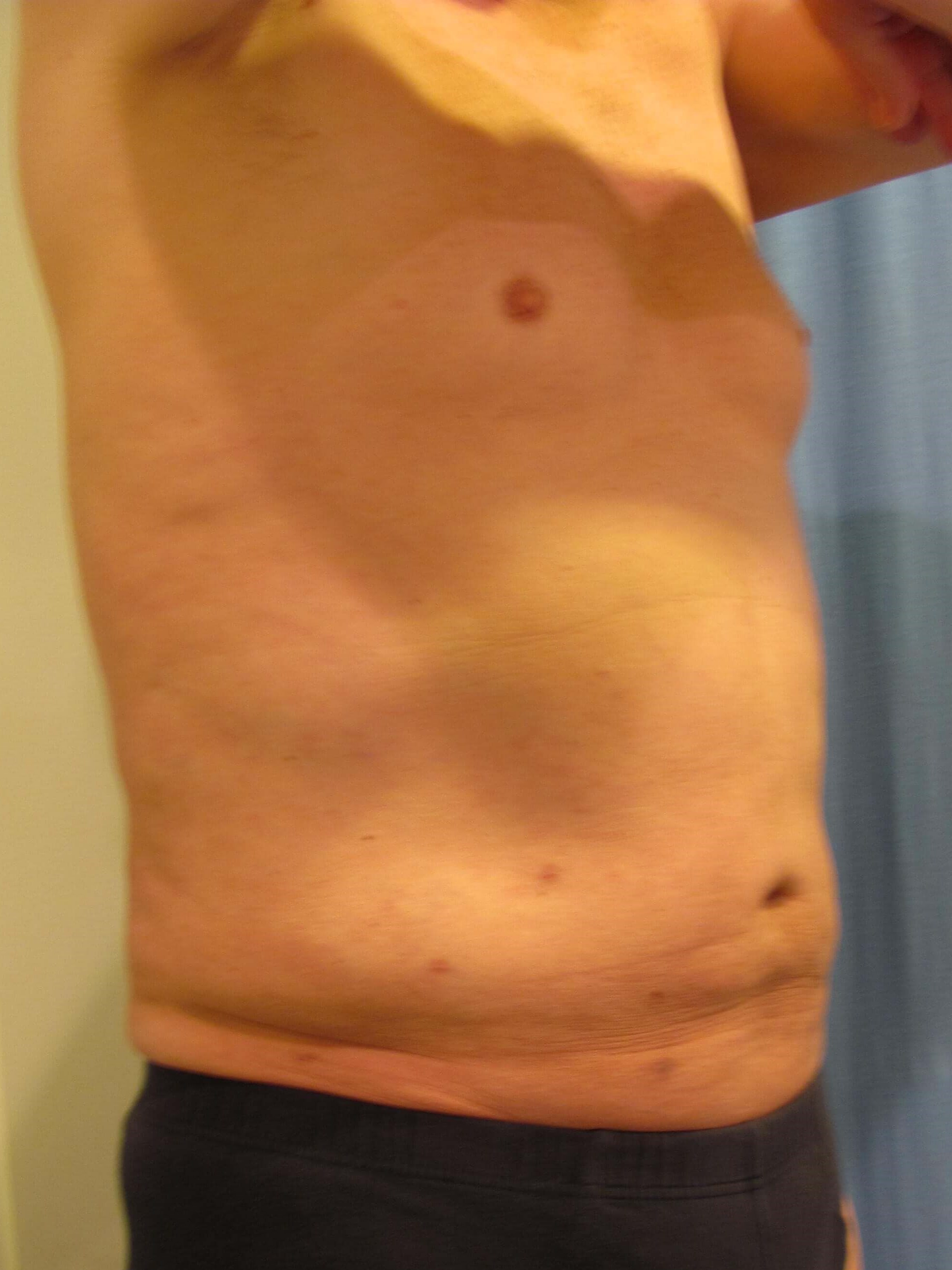Male Liposuction of Abdomen, Flanks and Chest Wall — after, view 3