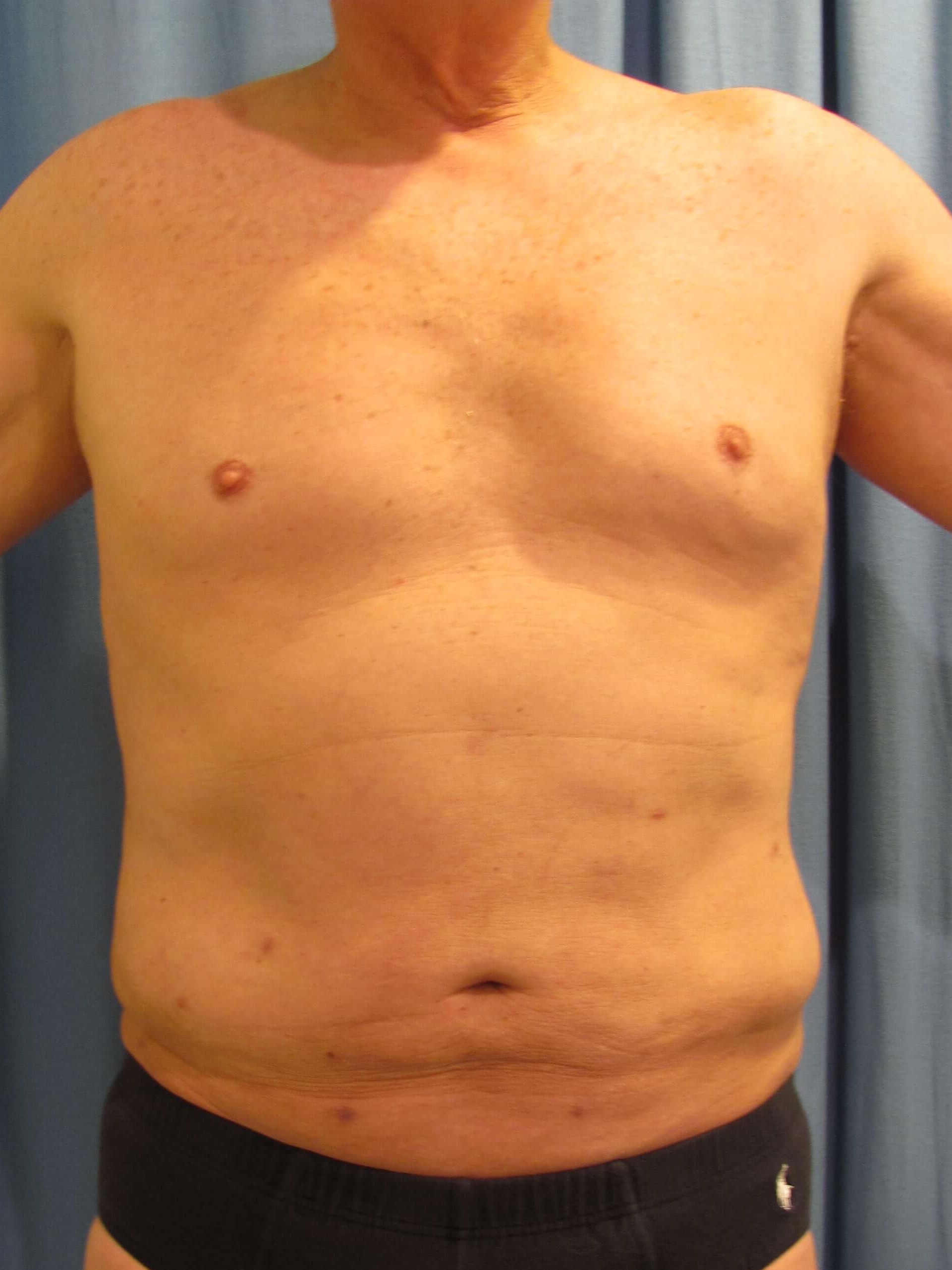 Male Liposuction of Abdomen, Flanks and Chest Wall — after, view 4