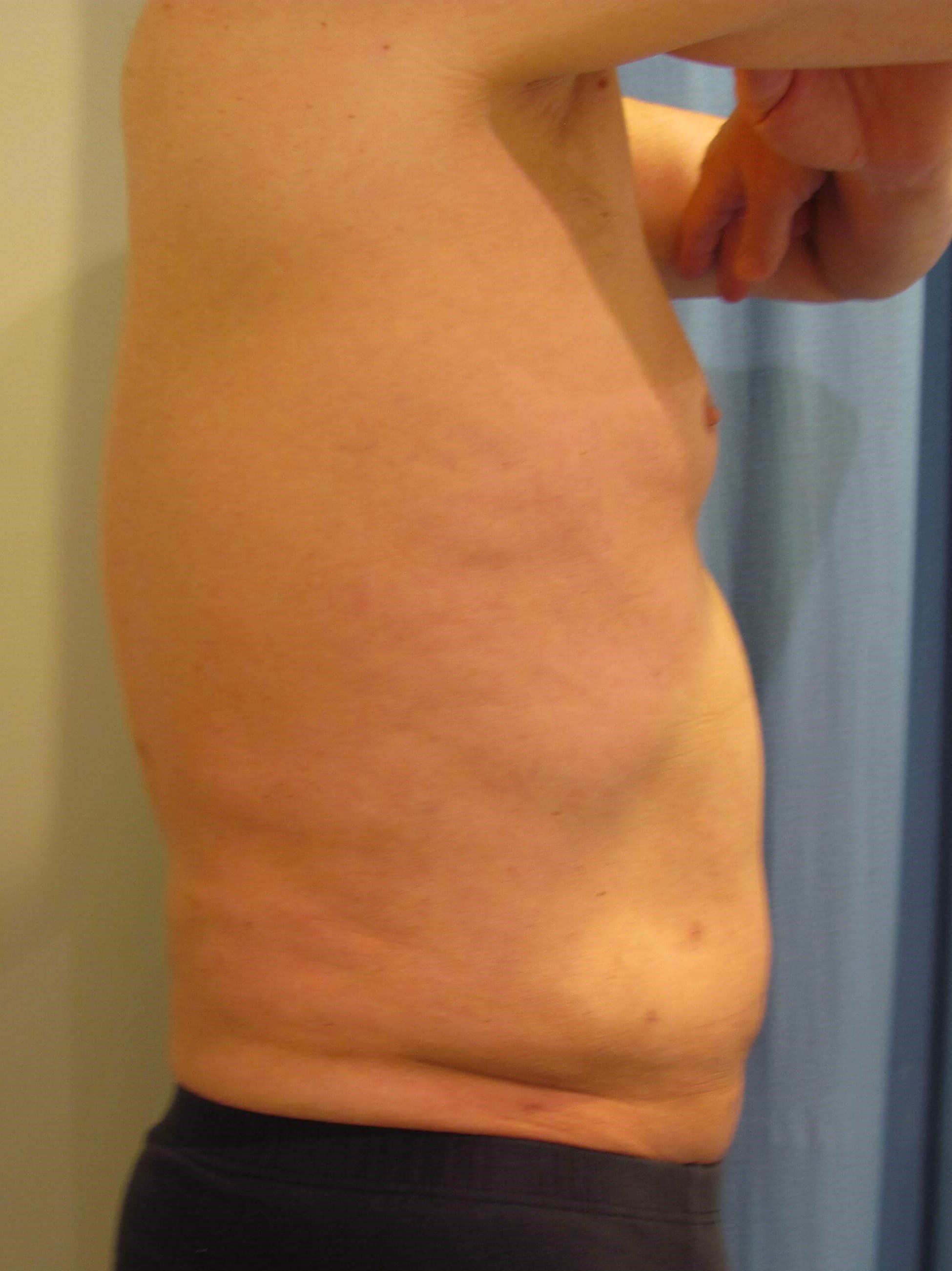 Male Liposuction of Abdomen, Flanks and Chest Wall — after, view 5