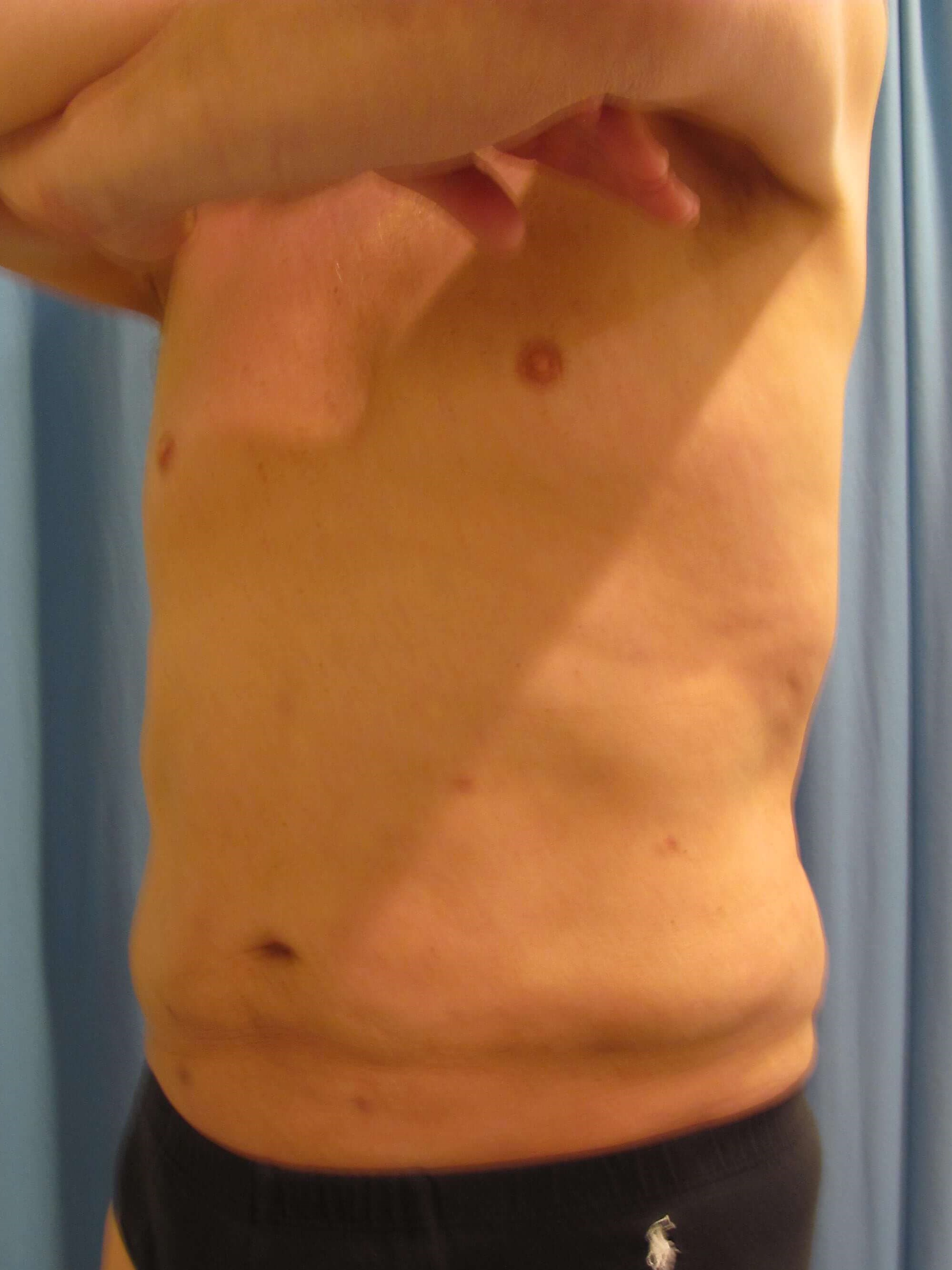 Male Liposuction of Abdomen, Flanks and Chest Wall — after, view 6
