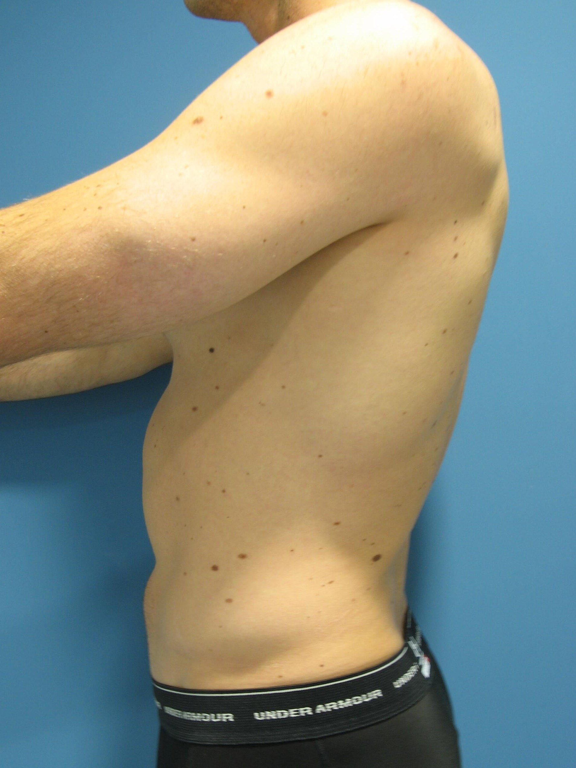 Liposuction Under Local in a 32 Year-Old Fit Gentleman for Spot Reduction — before, view 2