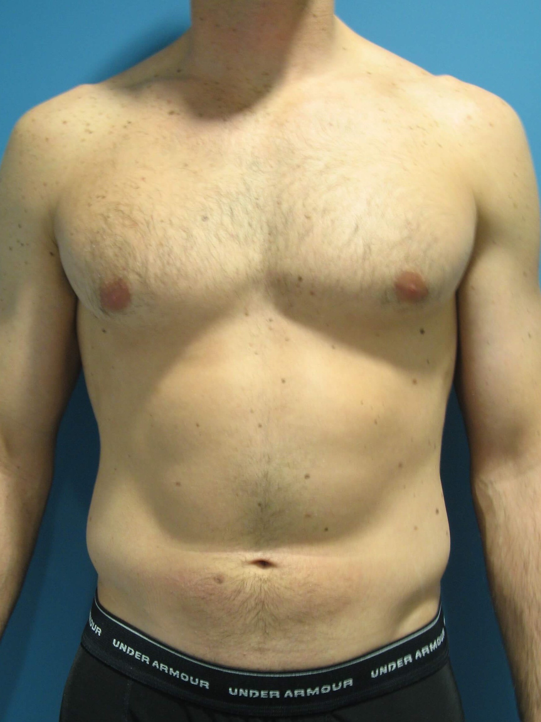 Liposuction Under Local in a 32 Year-Old Fit Gentleman for Spot Reduction — before, view 3