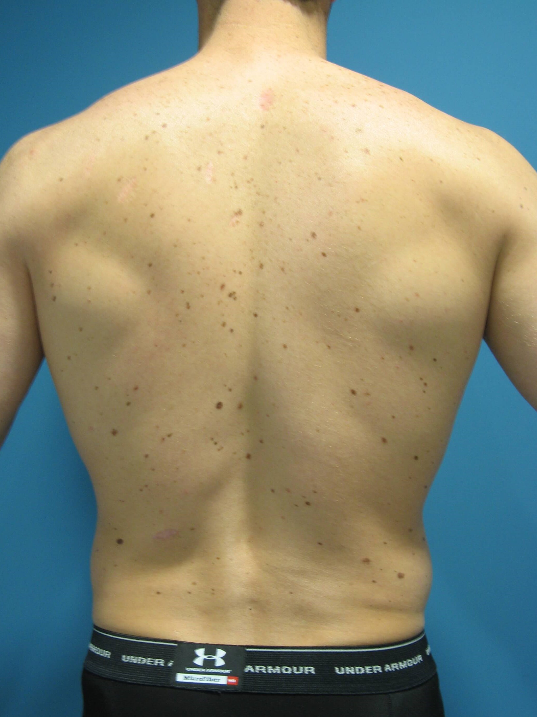 Liposuction Under Local in a 32 Year-Old Fit Gentleman for Spot Reduction — before, view 4