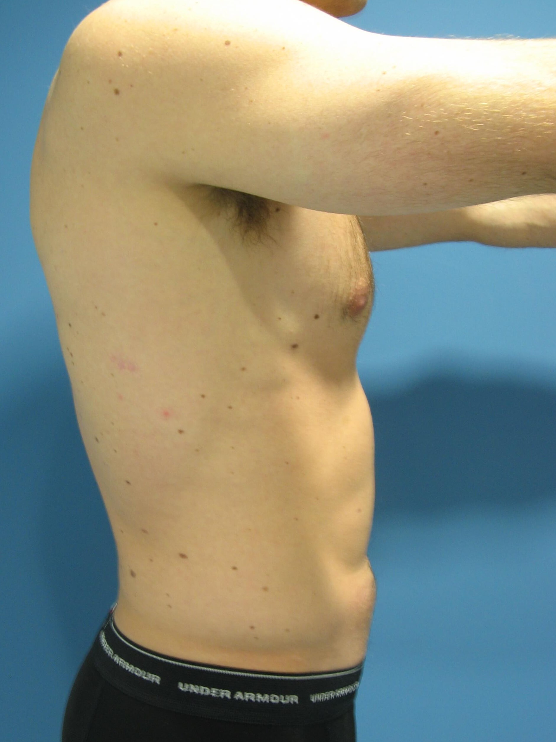 Liposuction Under Local in a 32 Year-Old Fit Gentleman for Spot Reduction — before, view 5