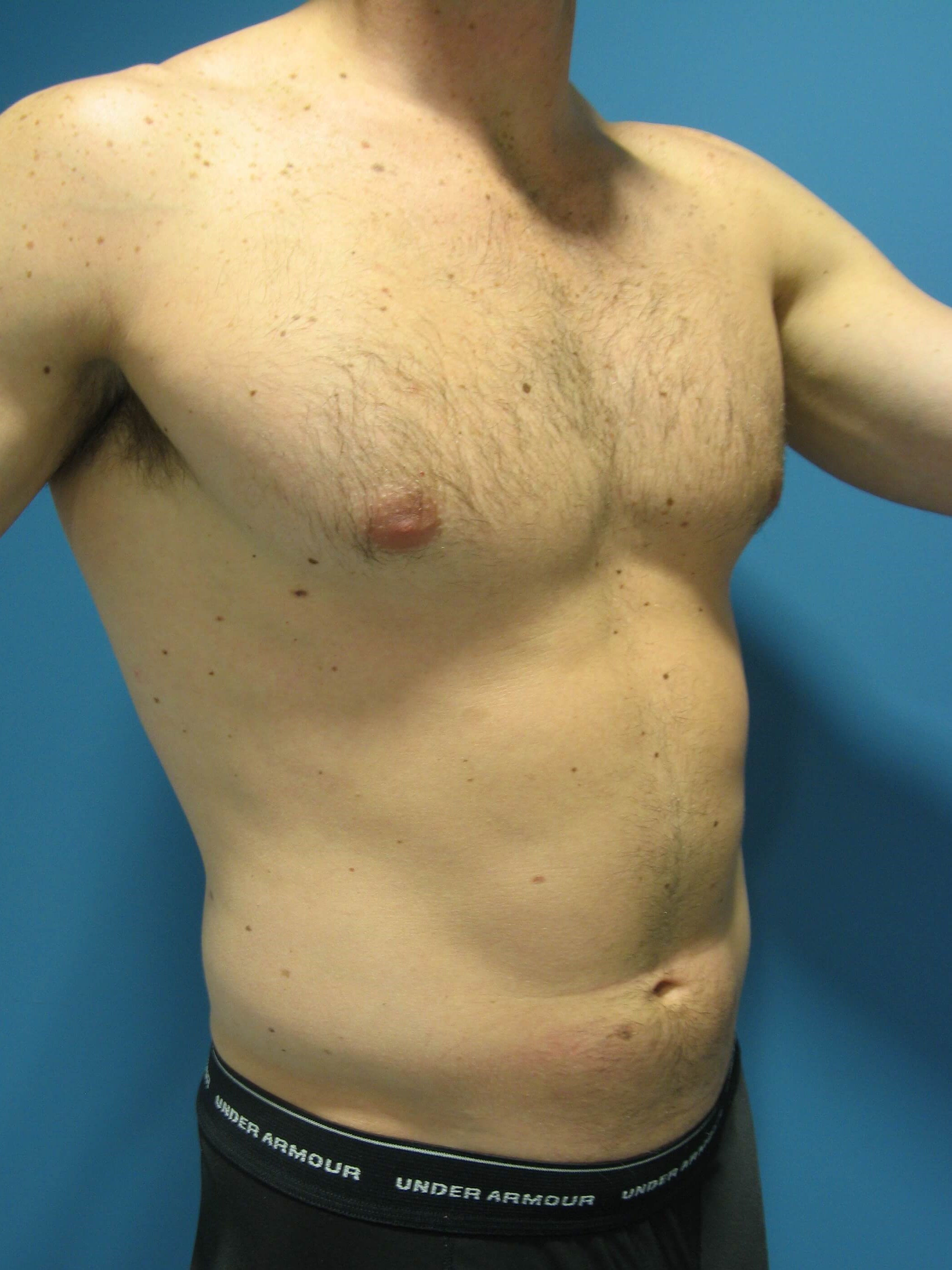 Liposuction Under Local in a 32 Year-Old Fit Gentleman for Spot Reduction — before, view 6