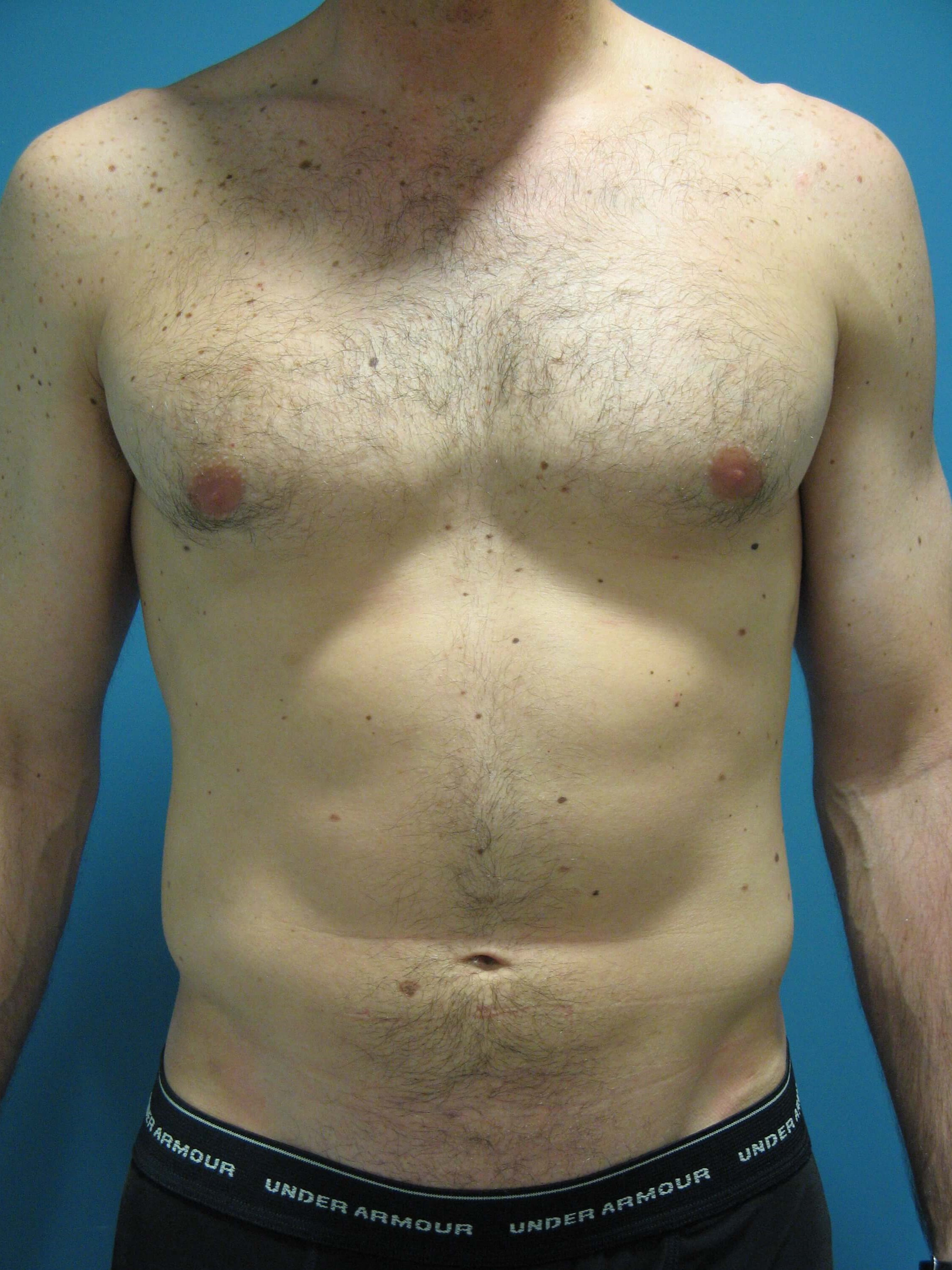Liposuction Under Local in a 32 Year-Old Fit Gentleman for Spot Reduction
