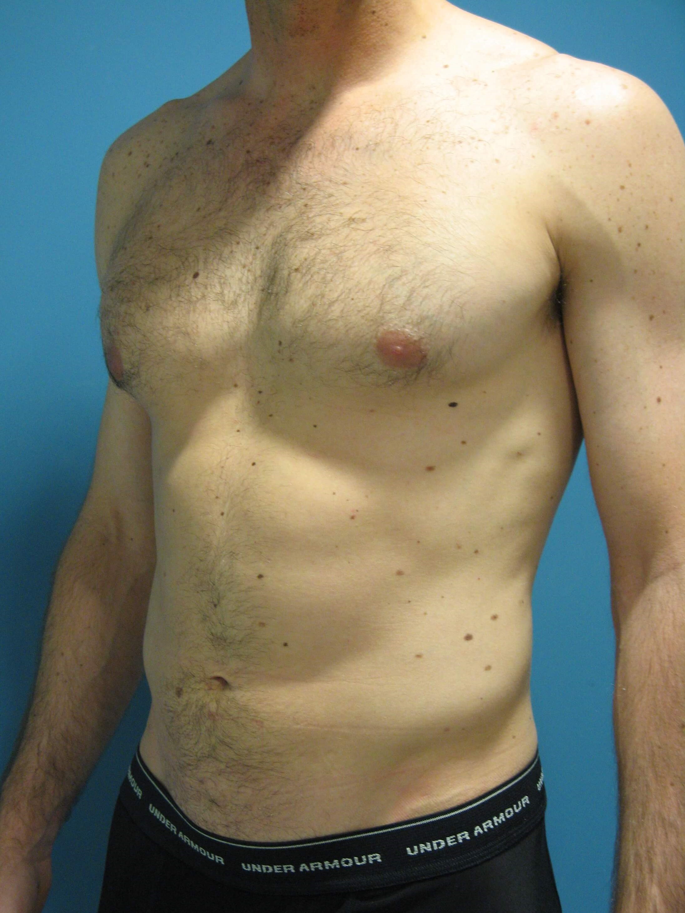Liposuction Under Local in a 32 Year-Old Fit Gentleman for Spot Reduction — after, view 2