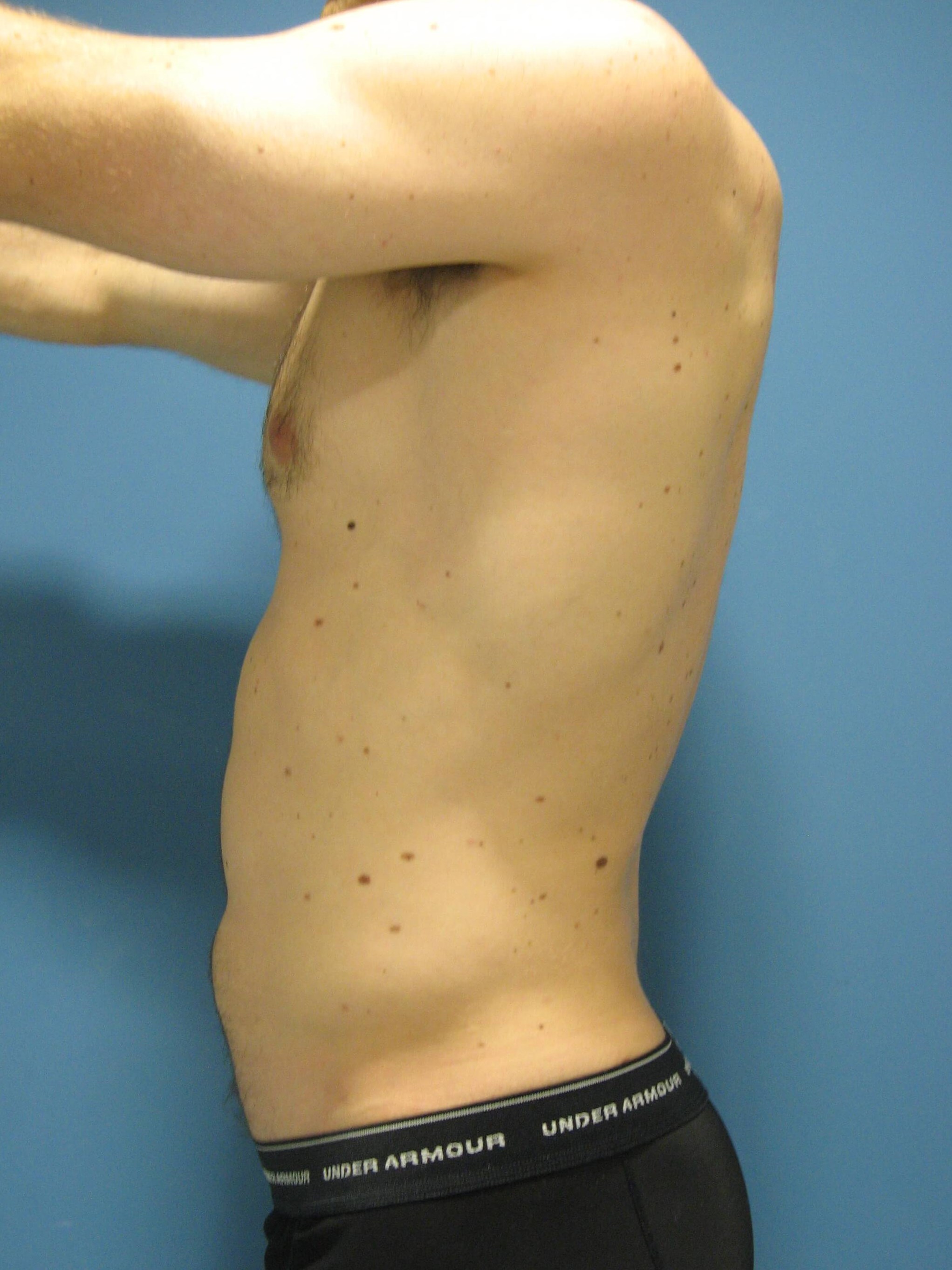 Liposuction Under Local in a 32 Year-Old Fit Gentleman for Spot Reduction — after, view 3