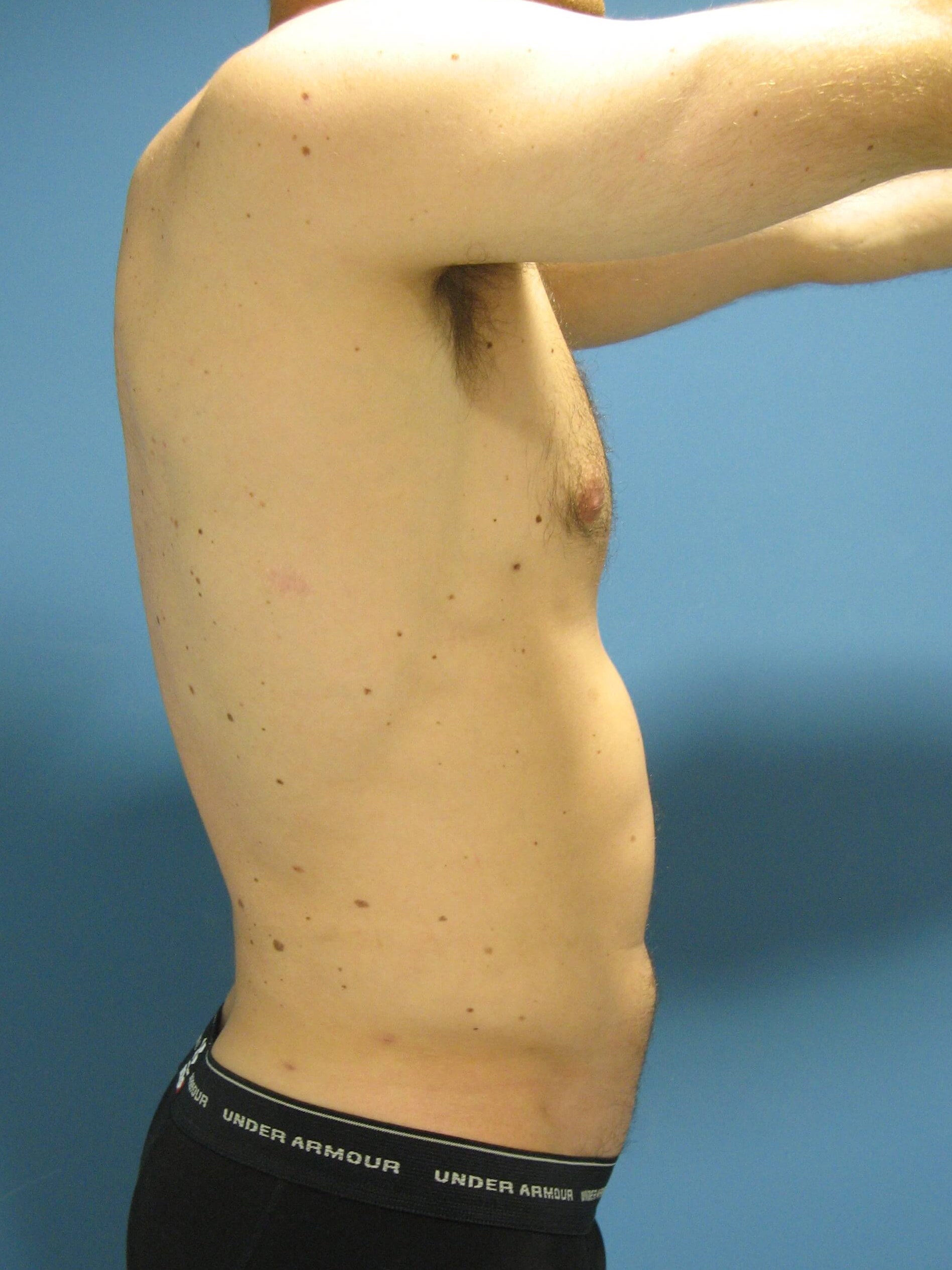 Liposuction Under Local in a 32 Year-Old Fit Gentleman for Spot Reduction — after, view 4