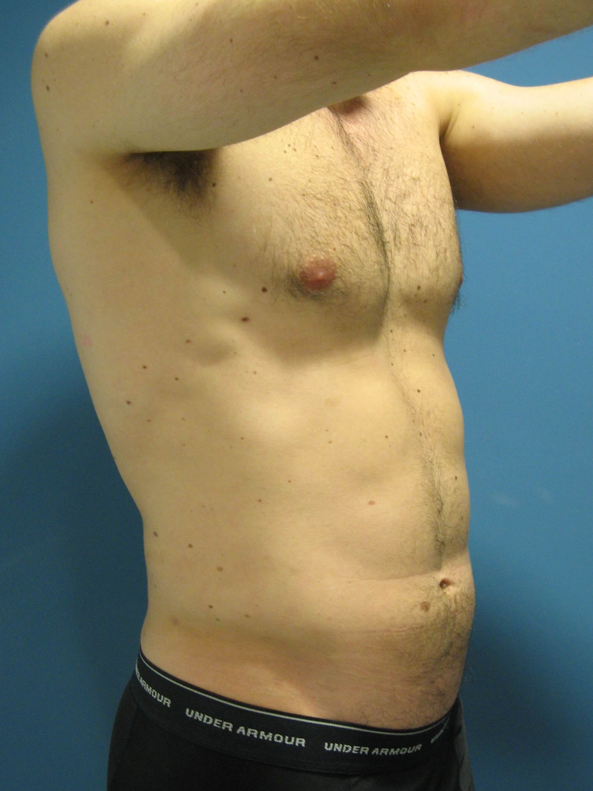 Liposuction Under Local in a 32 Year-Old Fit Gentleman for Spot Reduction — after, view 5