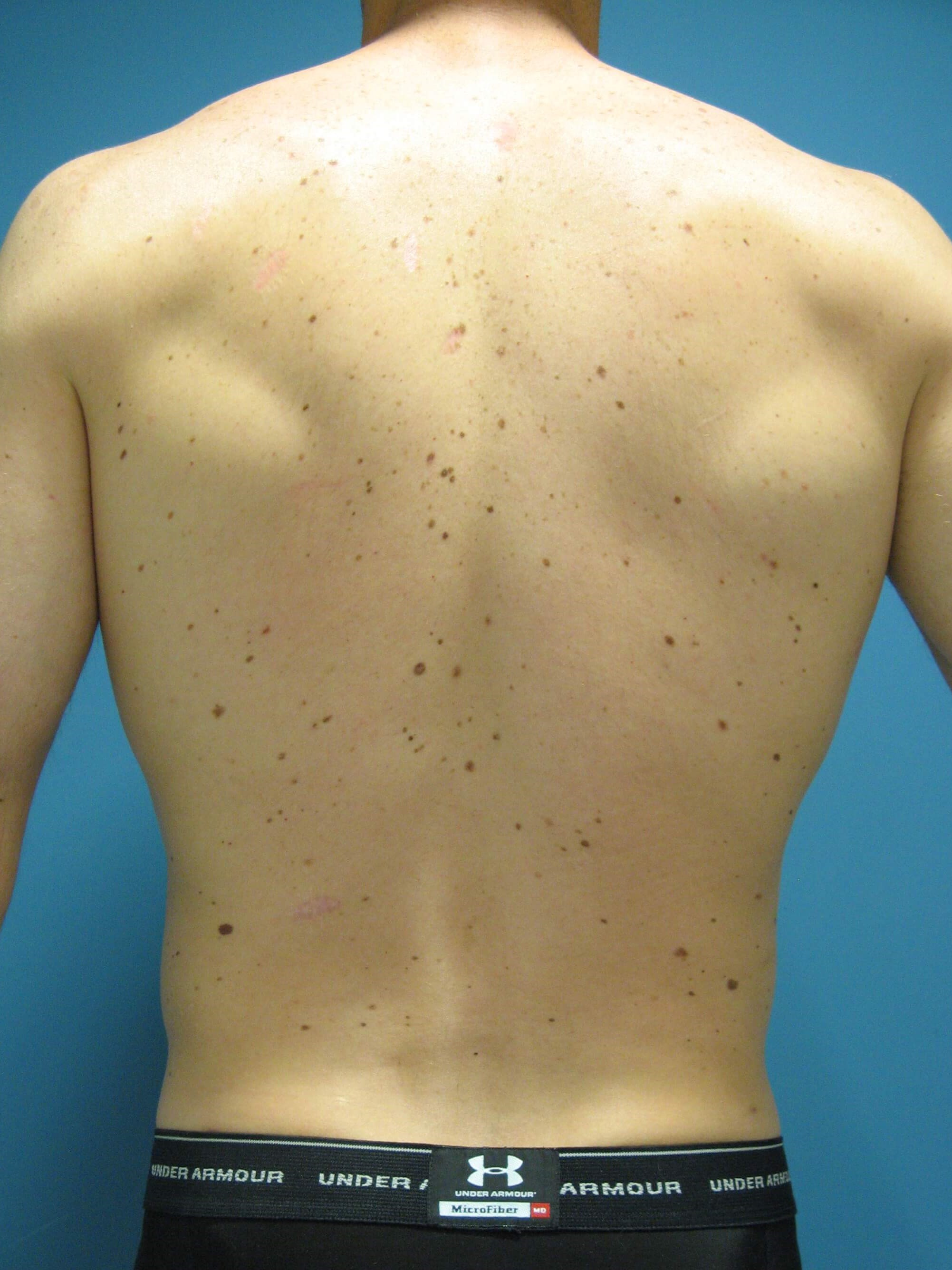 Liposuction Under Local in a 32 Year-Old Fit Gentleman for Spot Reduction — after, view 6
