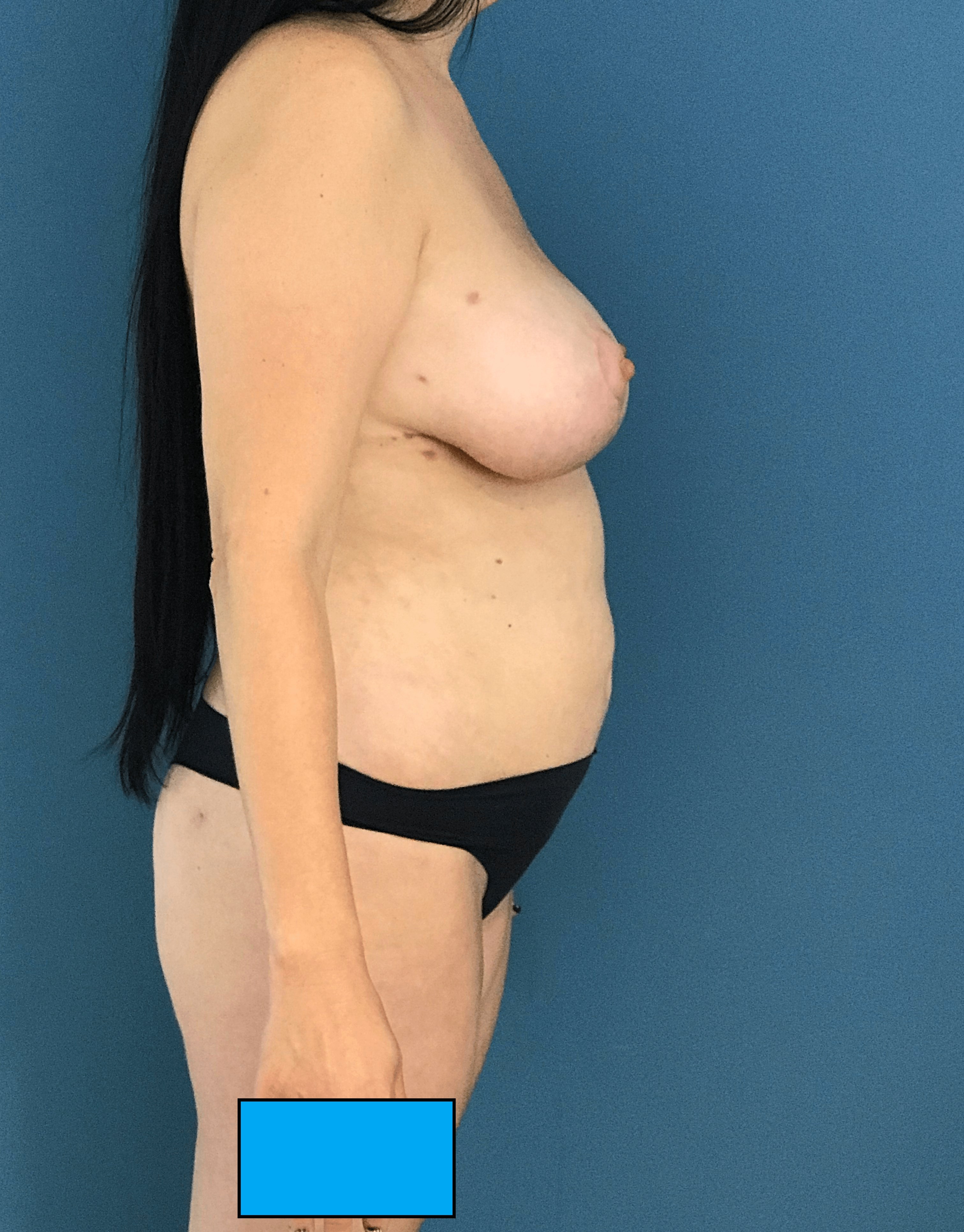 Mommy Makeover with Liposuction, Breast Lift and Fat Transfer — after, view 2