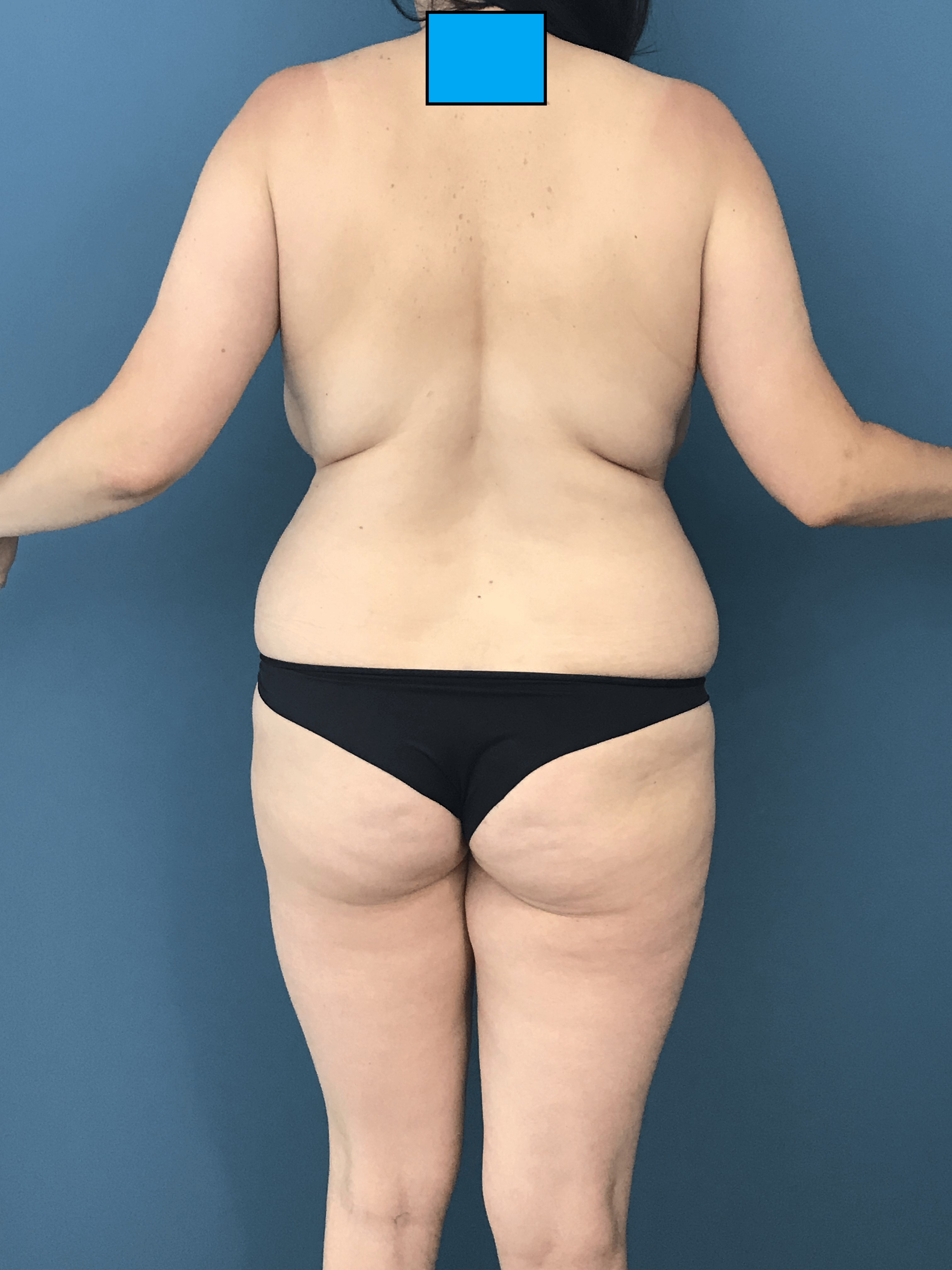 Mommy Makeover with Liposuction, Breast Lift and Fat Transfer — before, view 3