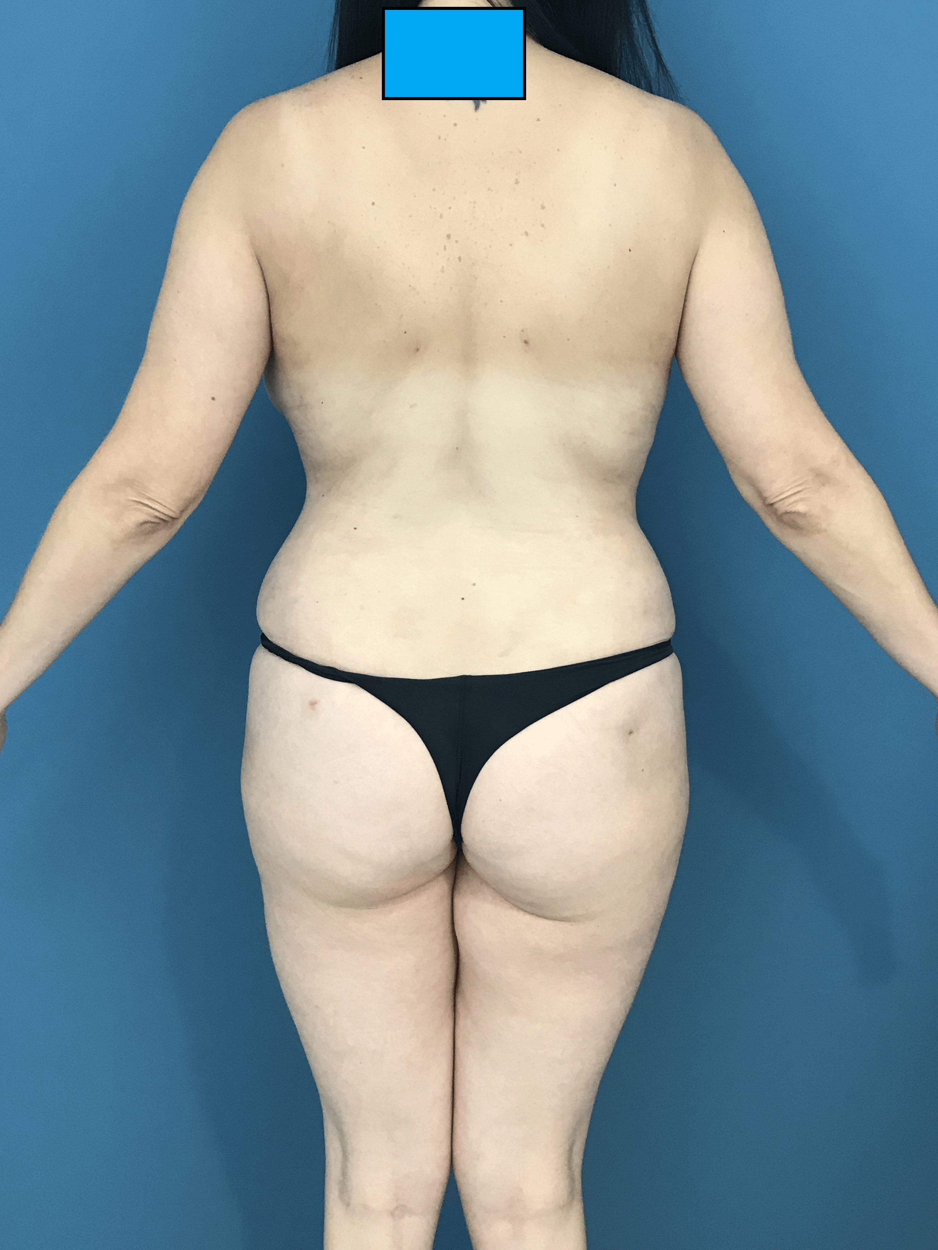 Mommy Makeover with Liposuction, Breast Lift and Fat Transfer — after, view 3