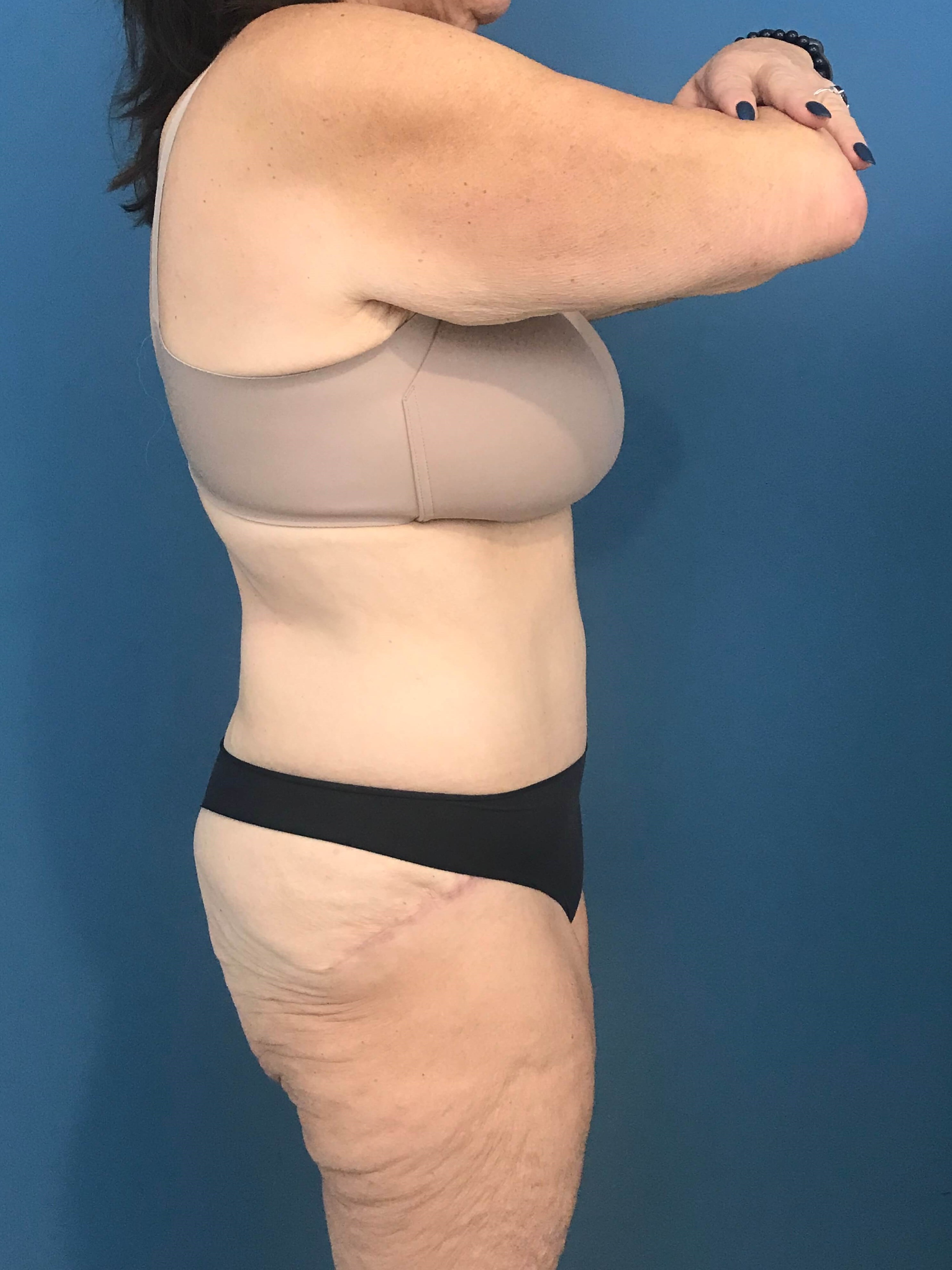 Skin-Only Full Abdominoplasty in a Massive Weight Loss Patient. — before, view 2