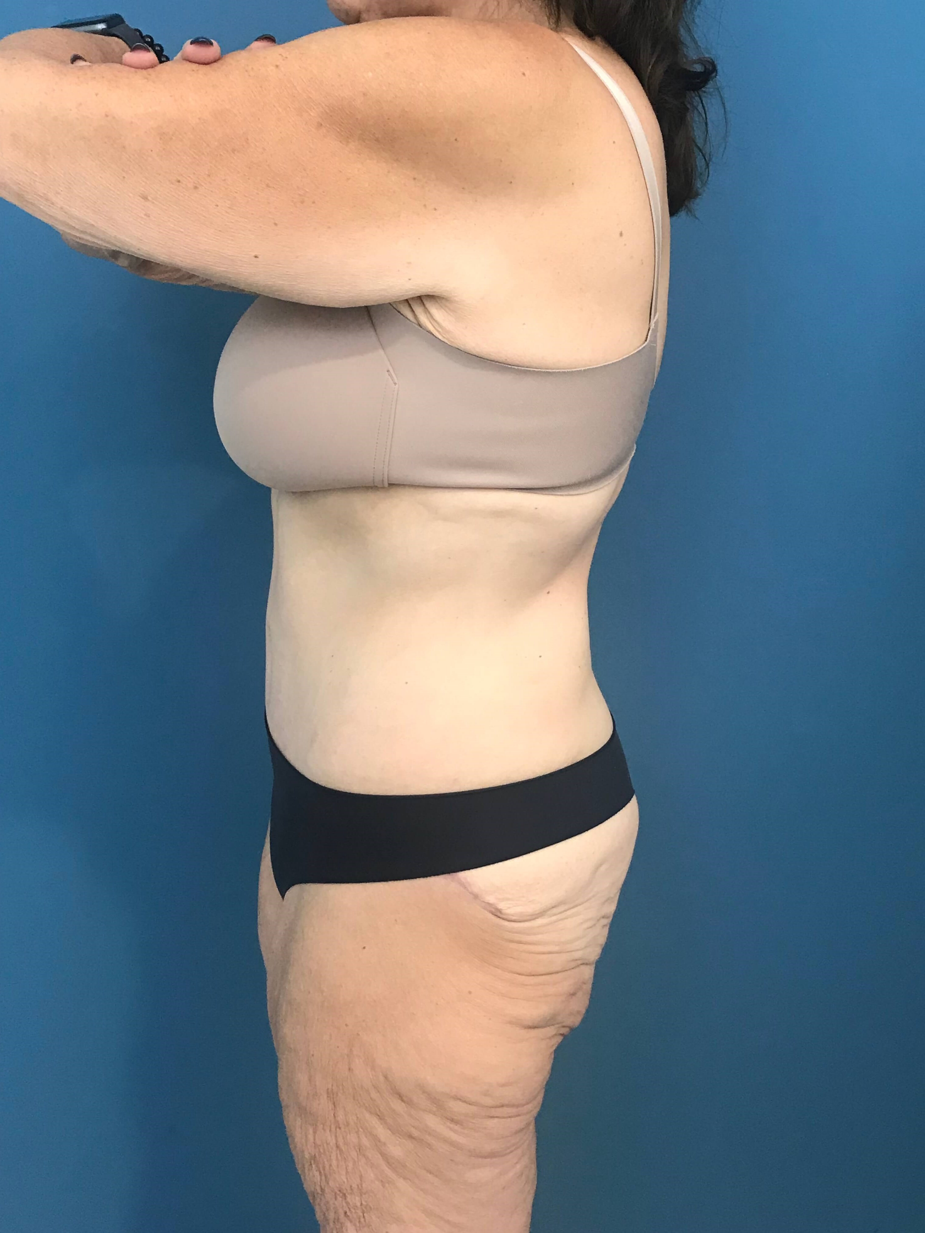 Skin-Only Full Abdominoplasty in a Massive Weight Loss Patient. — before, view 3
