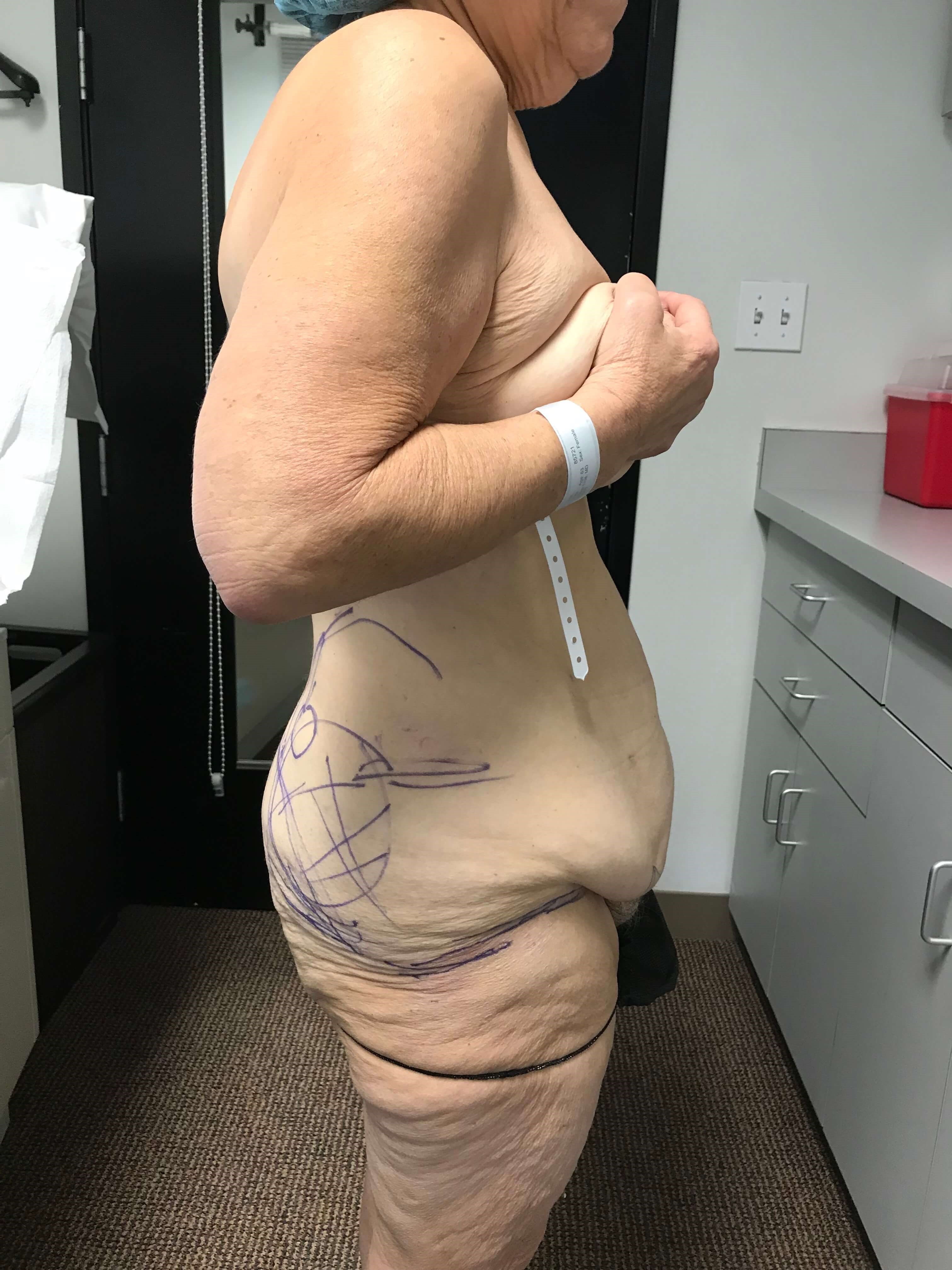 Skin-Only Full Abdominoplasty in a Massive Weight Loss Patient.