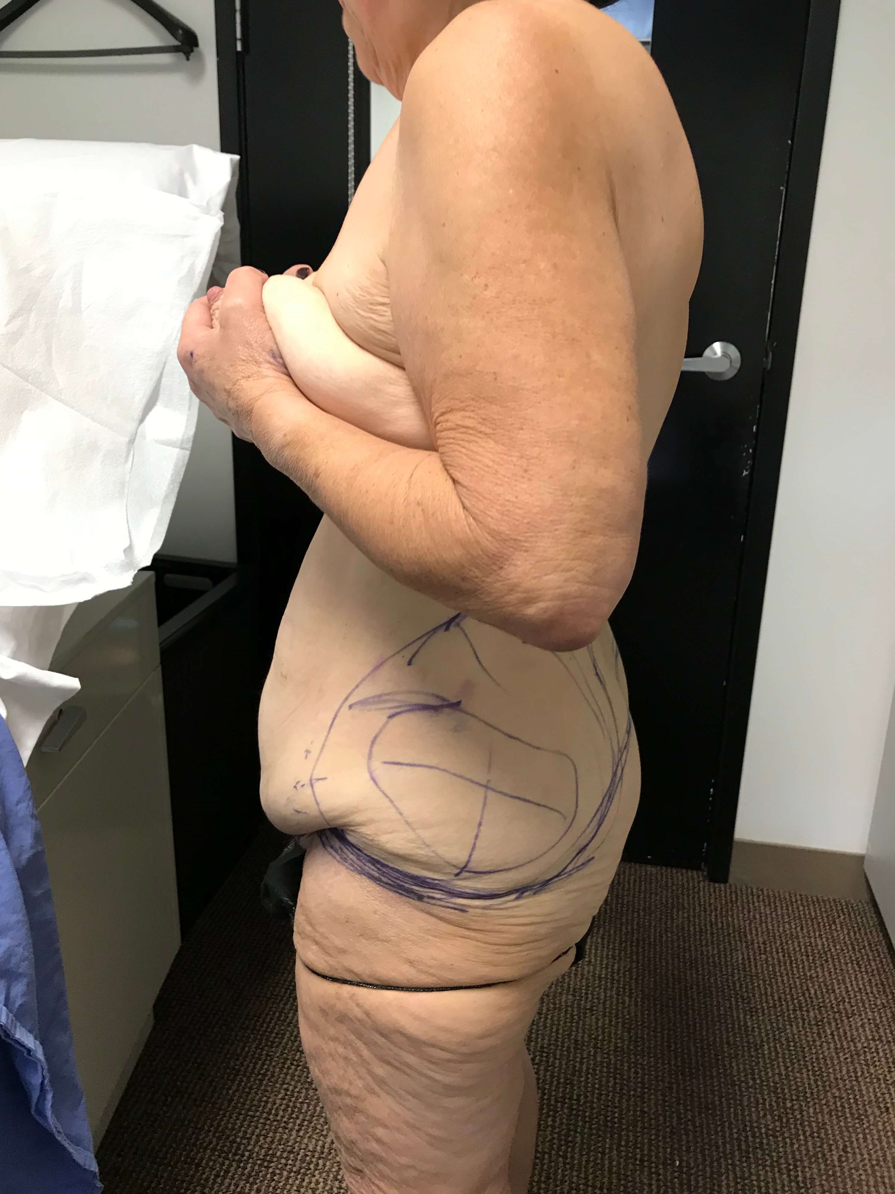 Skin-Only Full Abdominoplasty in a Massive Weight Loss Patient. — after, view 2