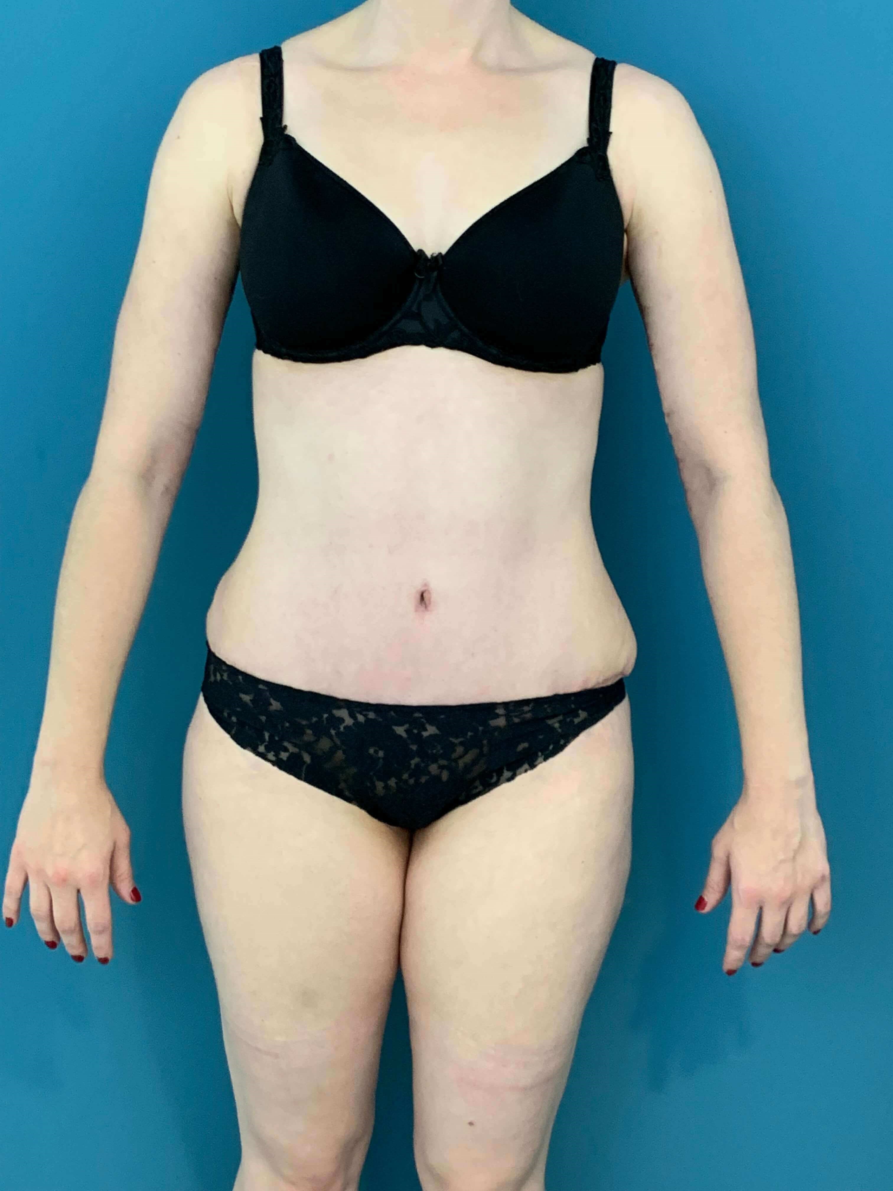 Skin-Only Extended Abdominoplasty — before, view 2