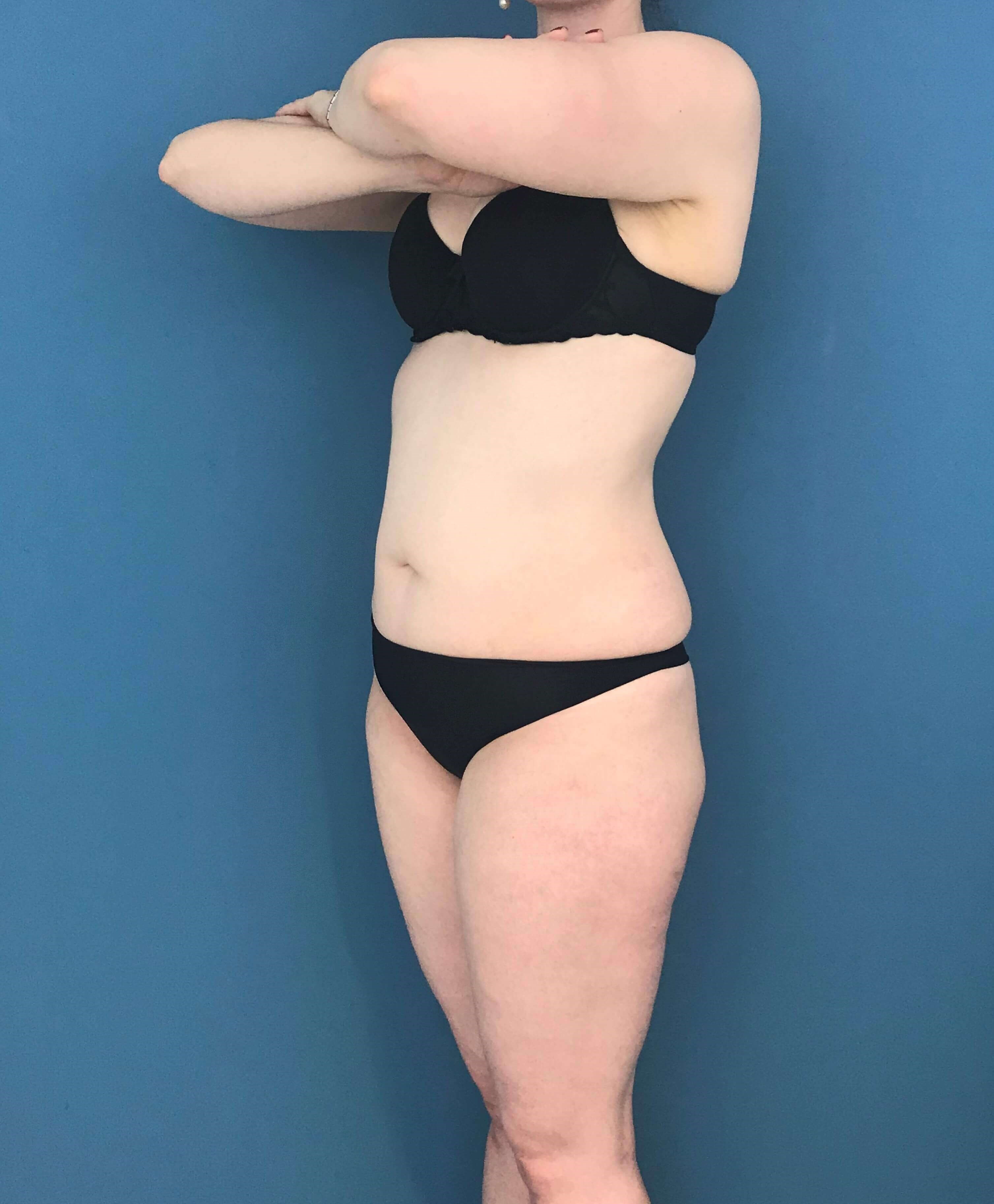 Skin-Only Extended Abdominoplasty — before, view 3