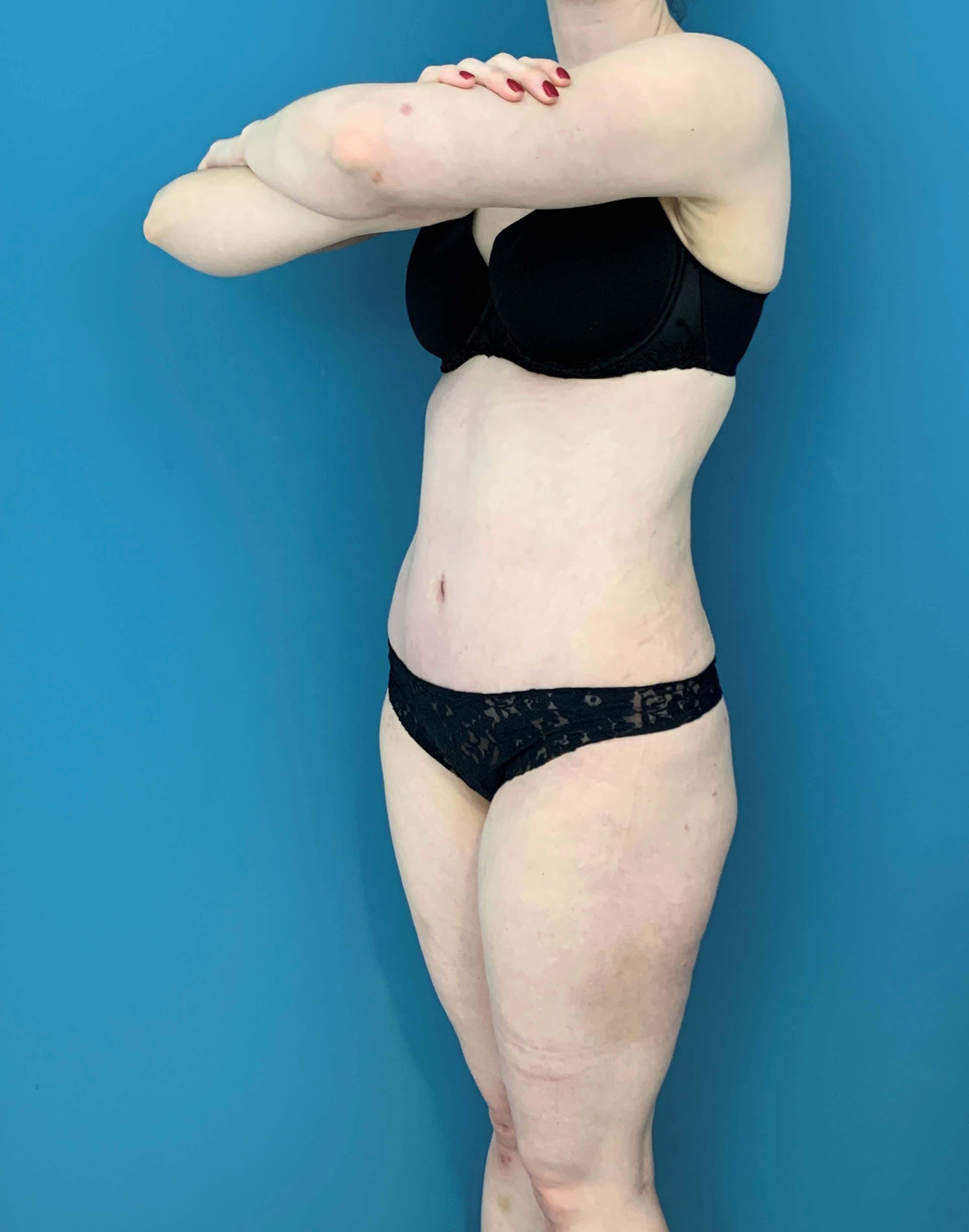 Skin-Only Extended Abdominoplasty — before, view 4