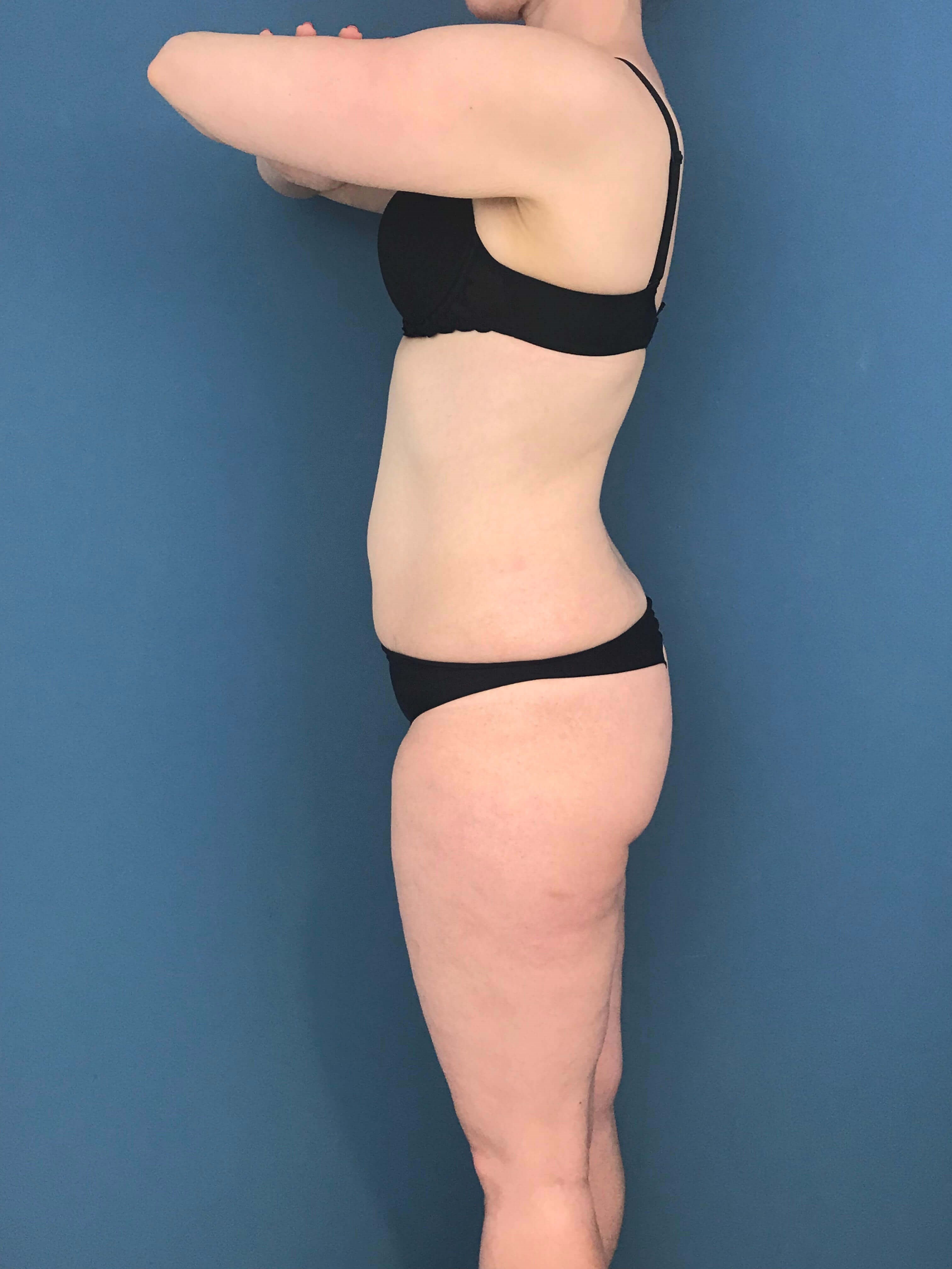 Skin-Only Extended Abdominoplasty — before, view 5