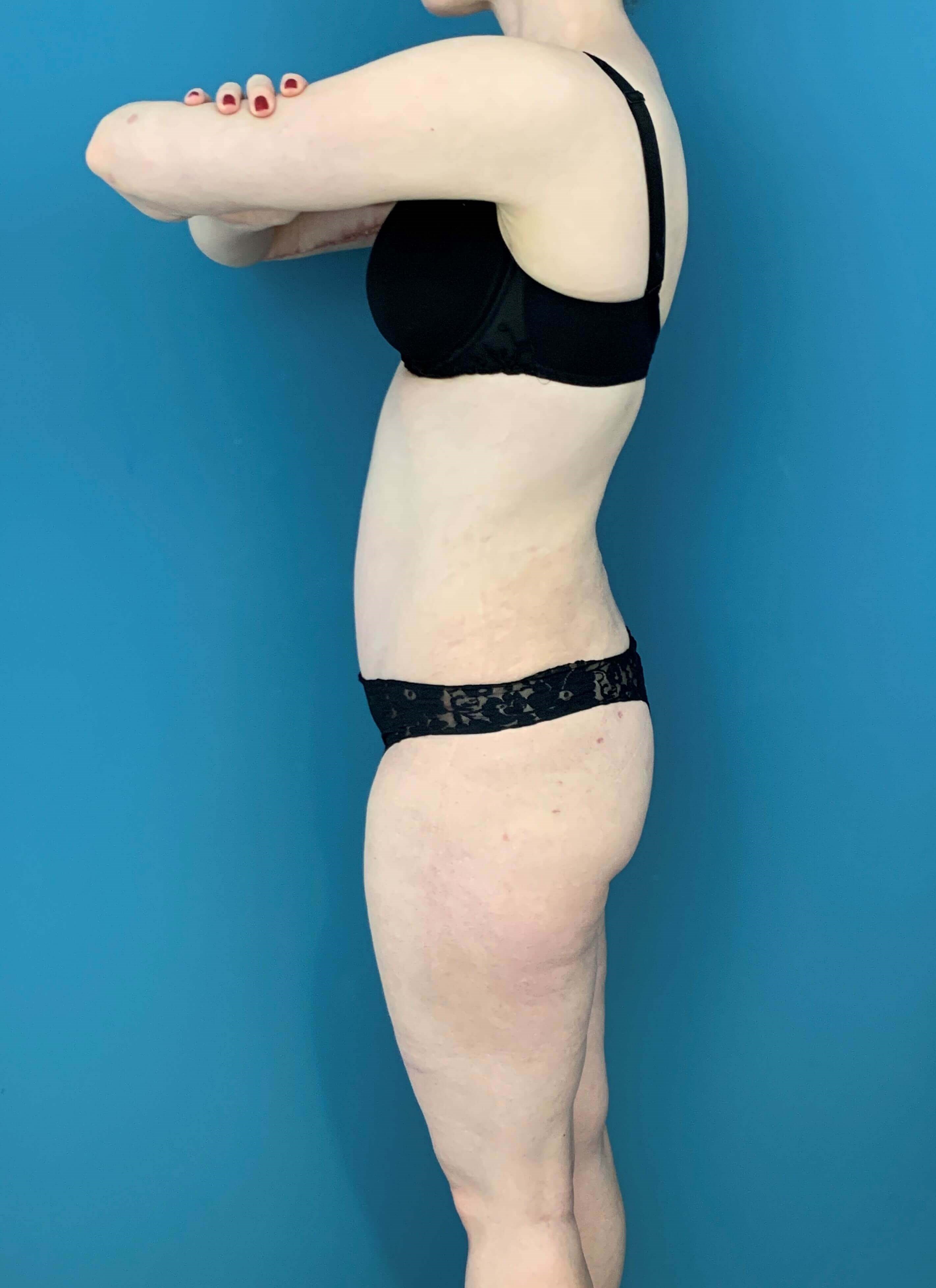 Skin-Only Extended Abdominoplasty