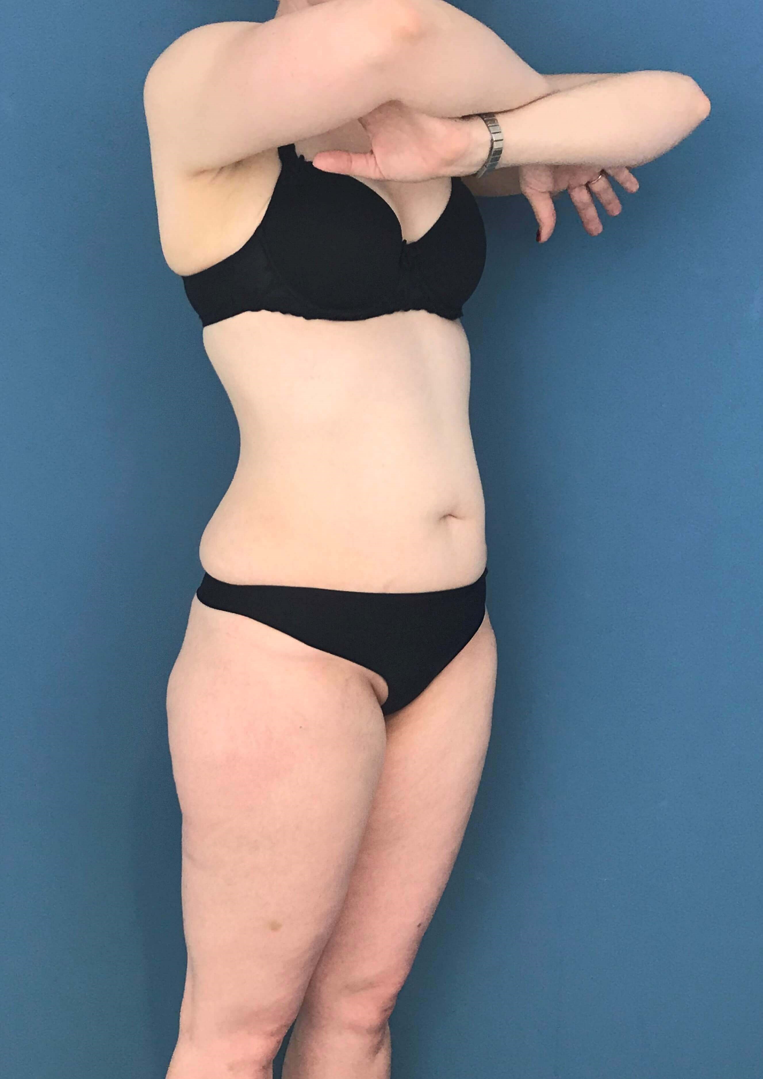 Skin-Only Extended Abdominoplasty — after, view 2