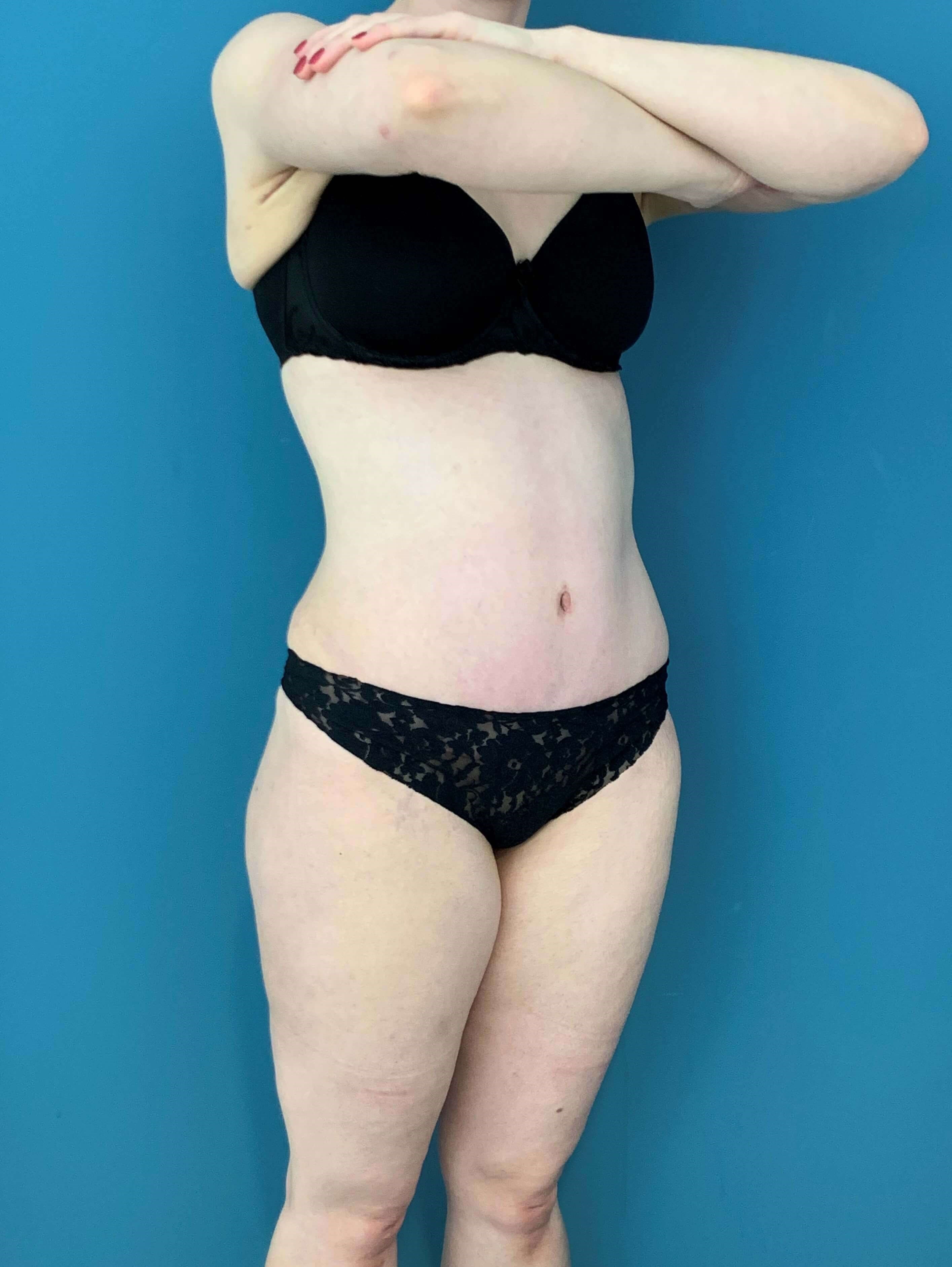 Skin-Only Extended Abdominoplasty — after, view 3