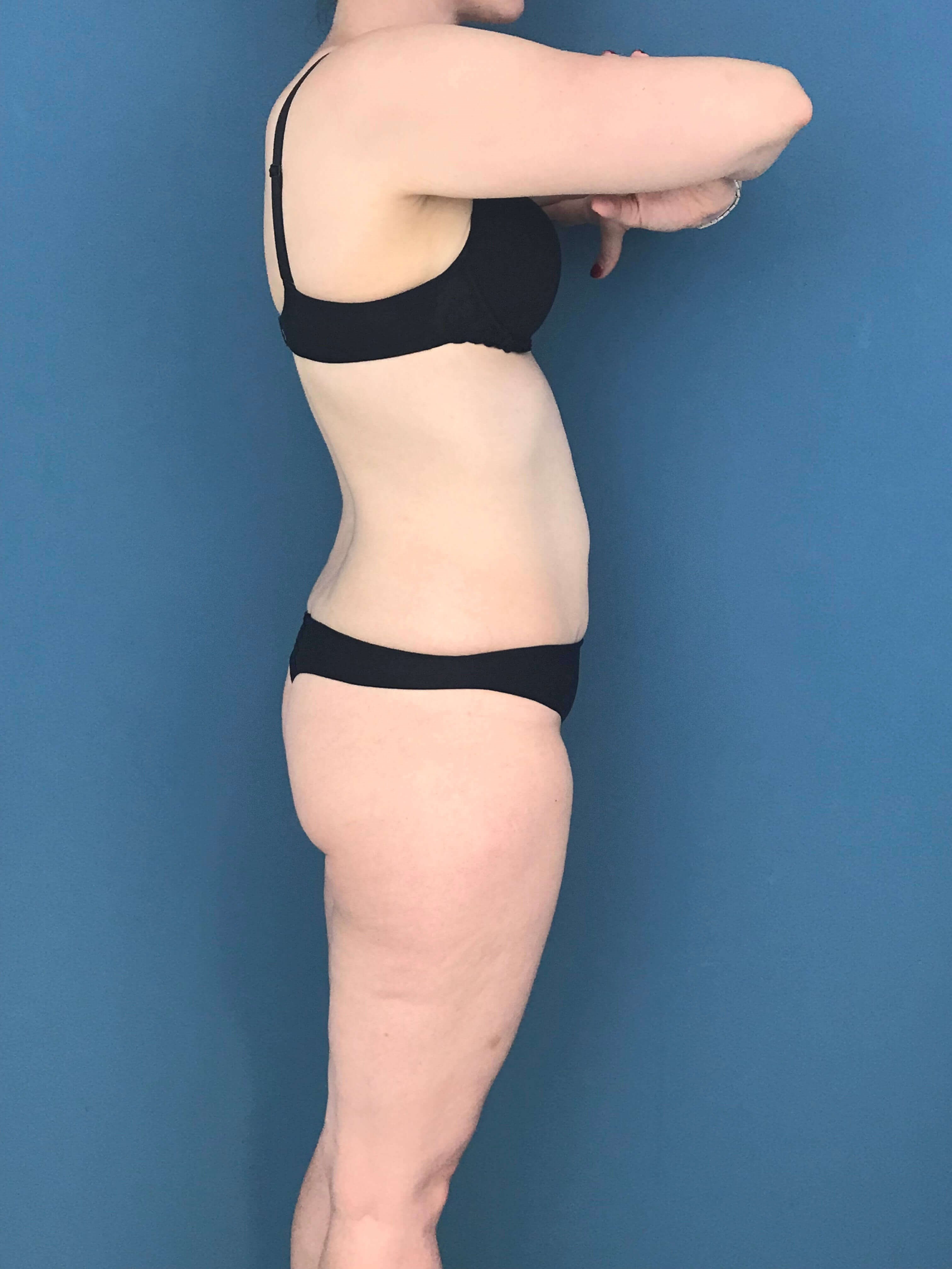 Skin-Only Extended Abdominoplasty — after, view 4