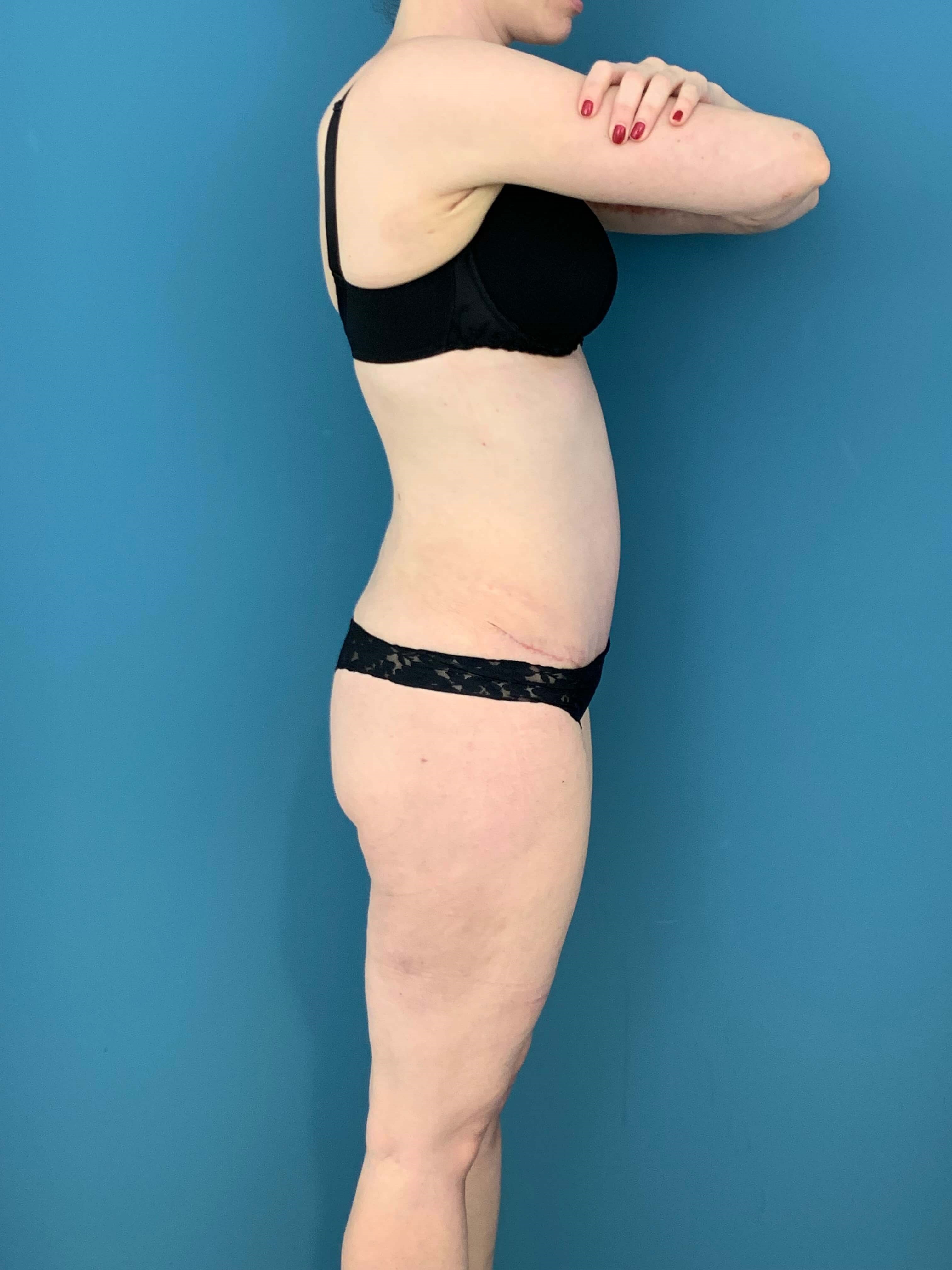 Skin-Only Extended Abdominoplasty — after, view 5