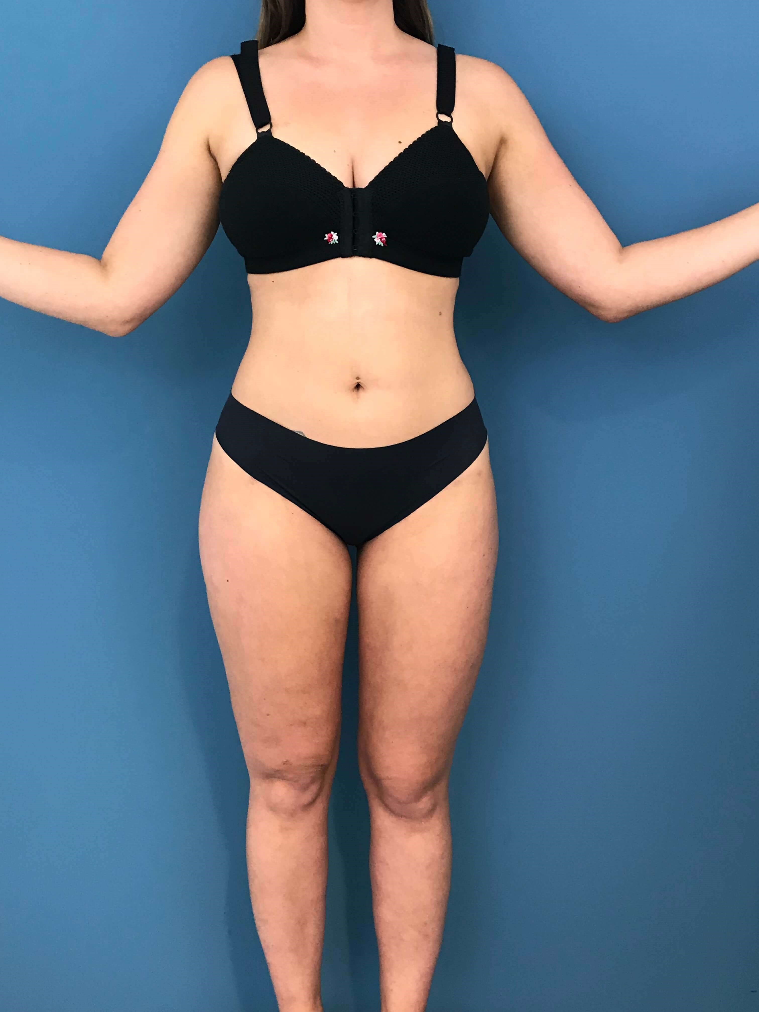 Full Body Contouring with Liposuction on a Thirty Year-Old Woman