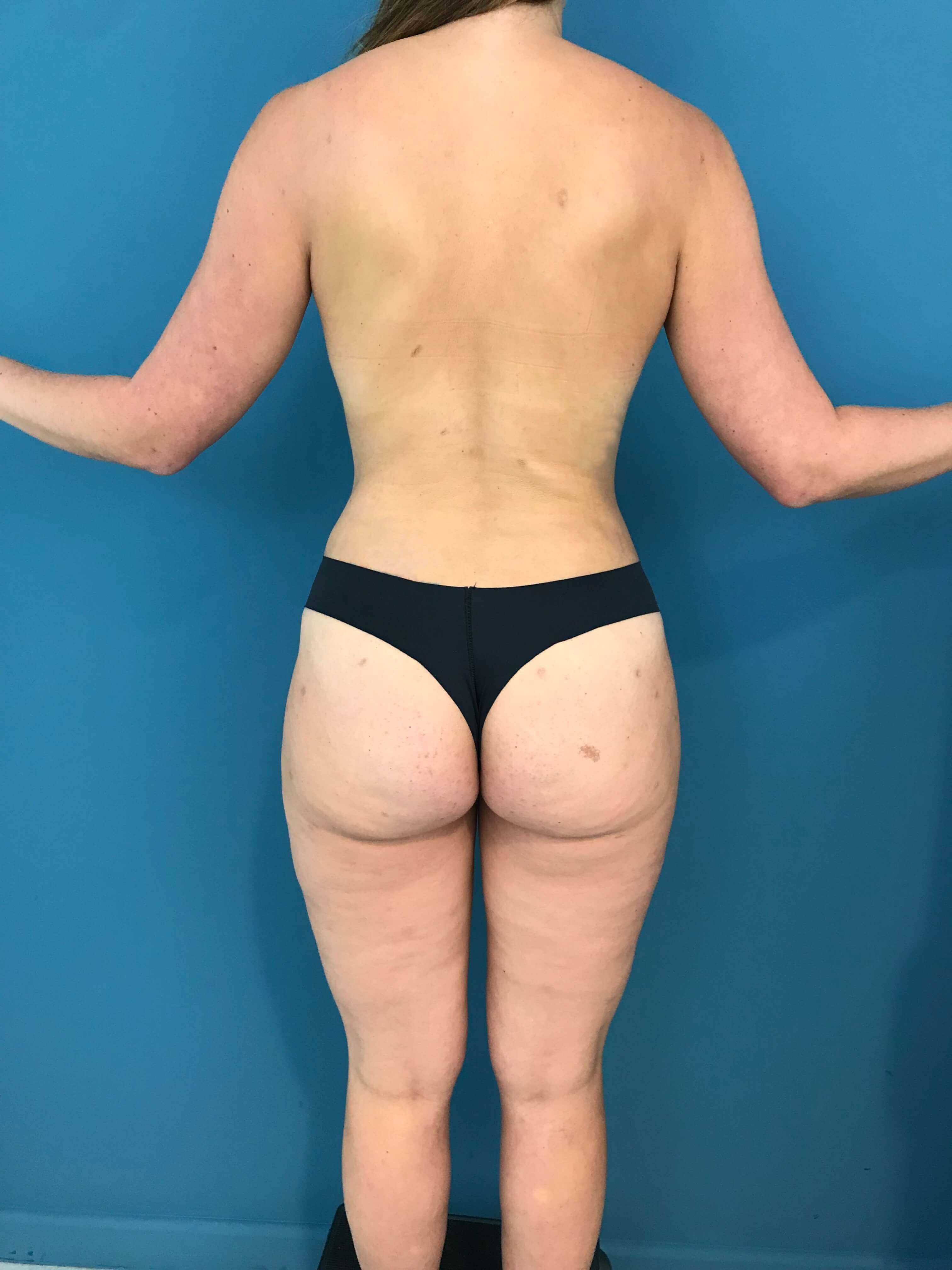 Full Body Contouring with Liposuction on a Thirty Year-Old Woman — after, view 2