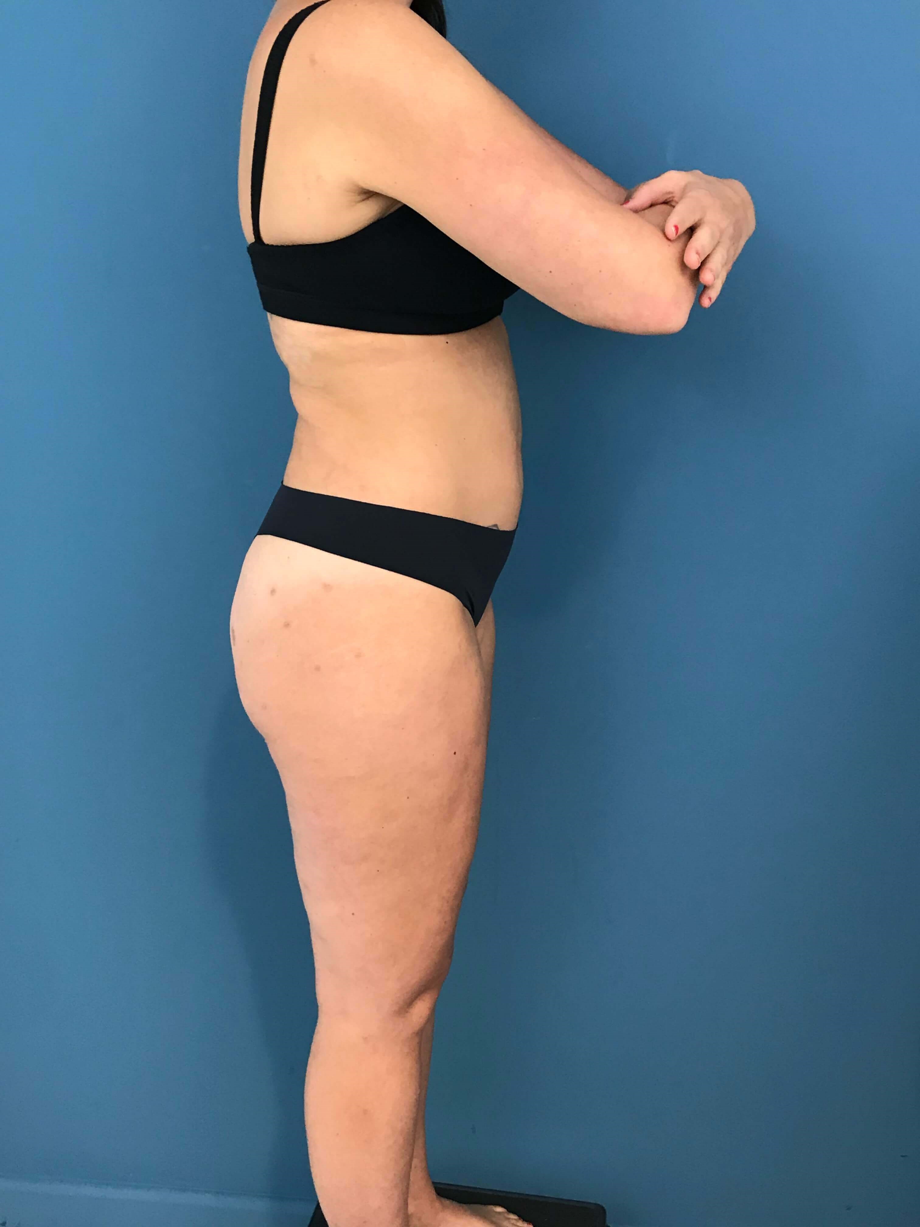 Full Body Contouring with Liposuction on a Thirty Year-Old Woman — after, view 4
