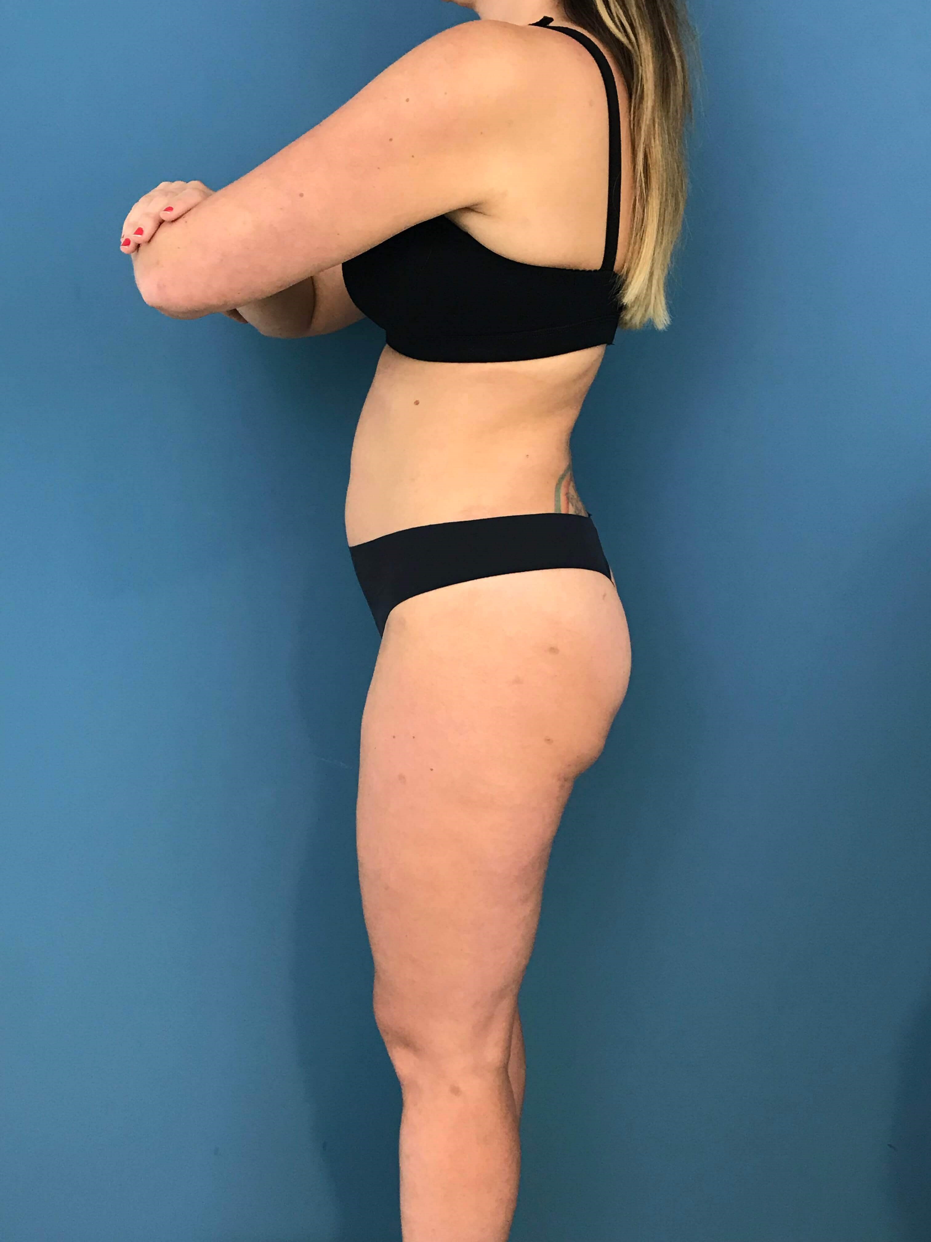 Full Body Contouring with Liposuction on a Thirty Year-Old Woman — after, view 3