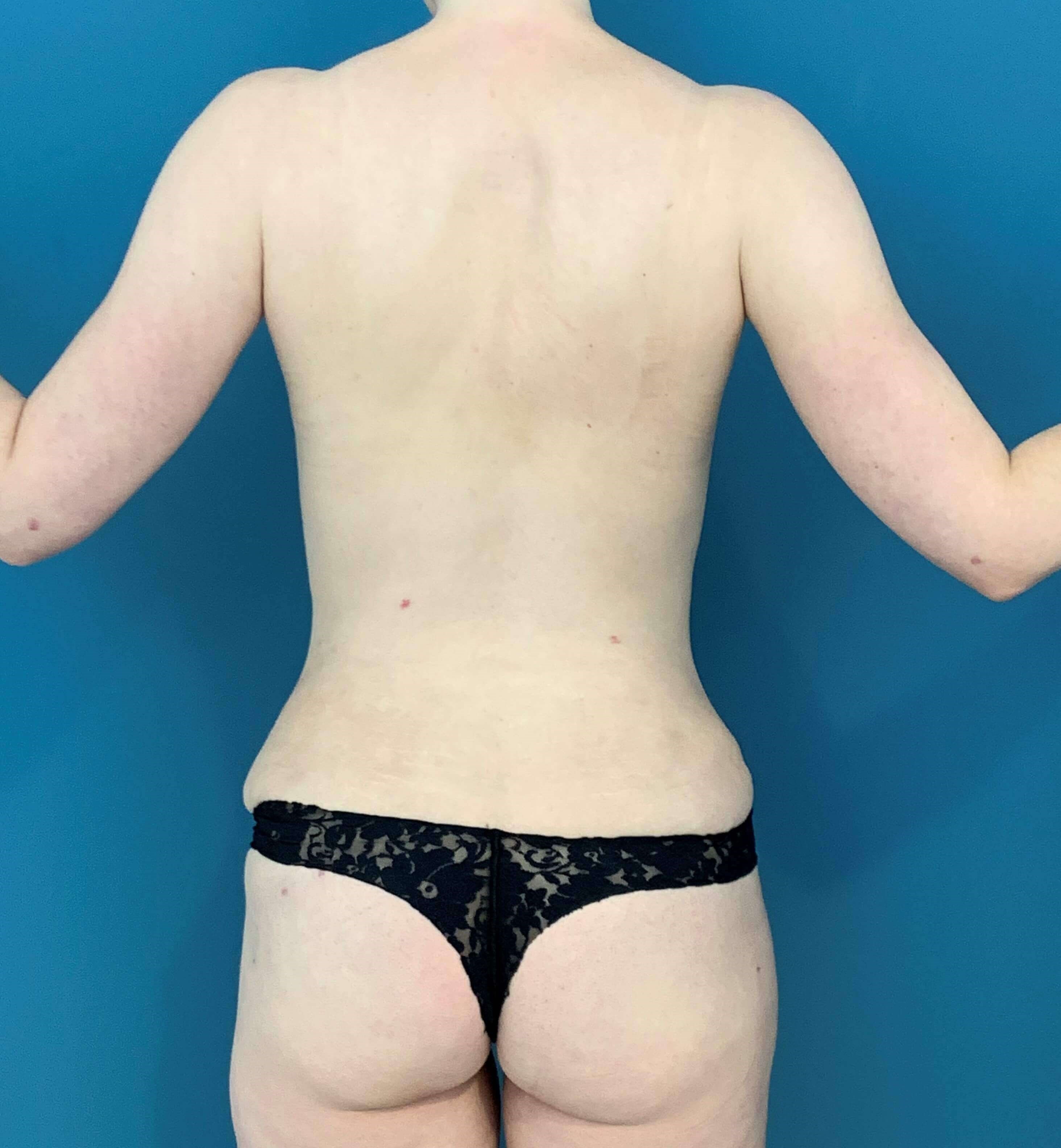 Bilateral Brachioplasty (Arm Lift) and Arm Liposuction