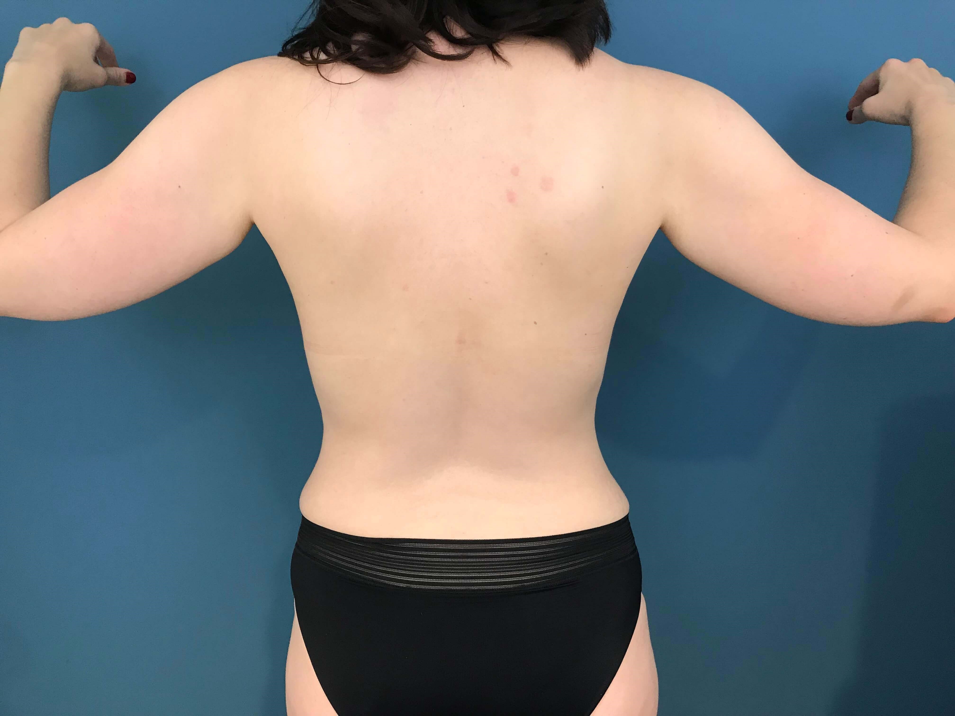 Bilateral Brachioplasty (Arm Lift) and Arm Liposuction — before, view 1